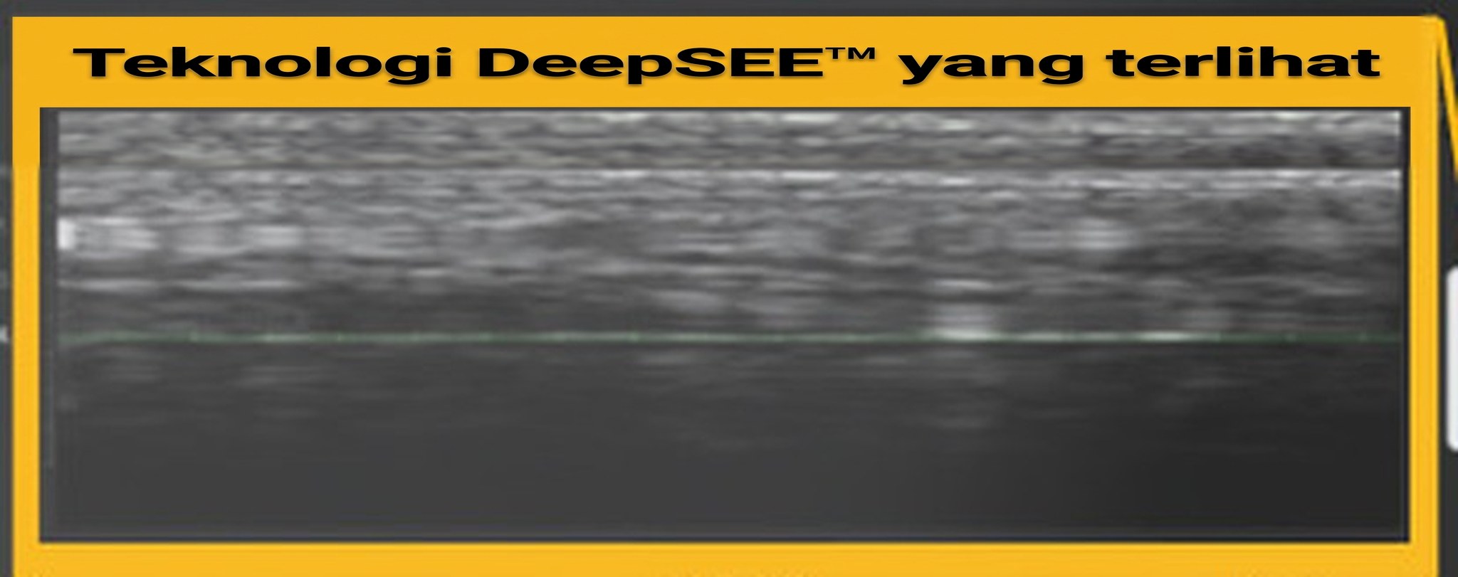 Callout DeepSEE pada layar Ultherapy PRIME — penampang ultrasound bagian dalam kulit secara real time