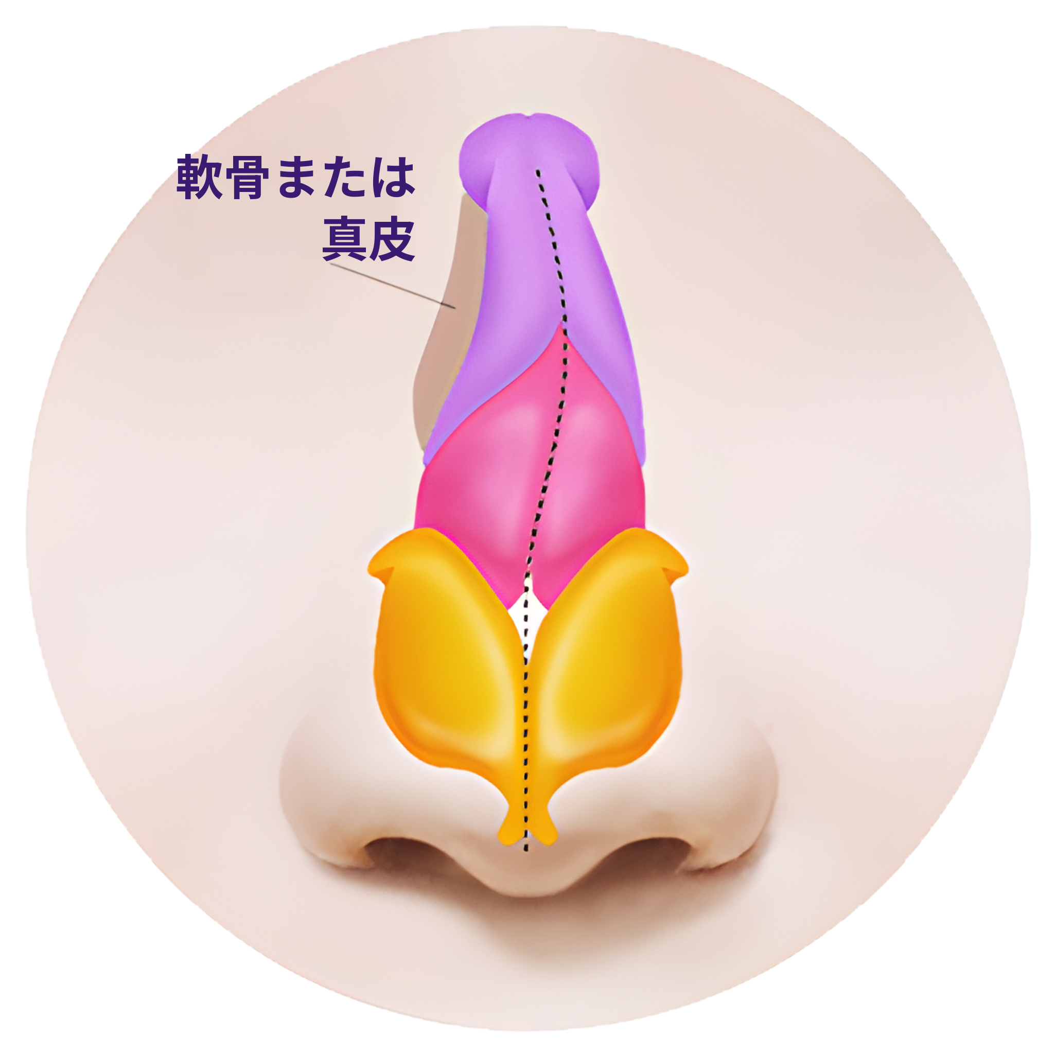 へこんだ部位に軟骨または真皮を移植して補った鼻の正面断面イラスト