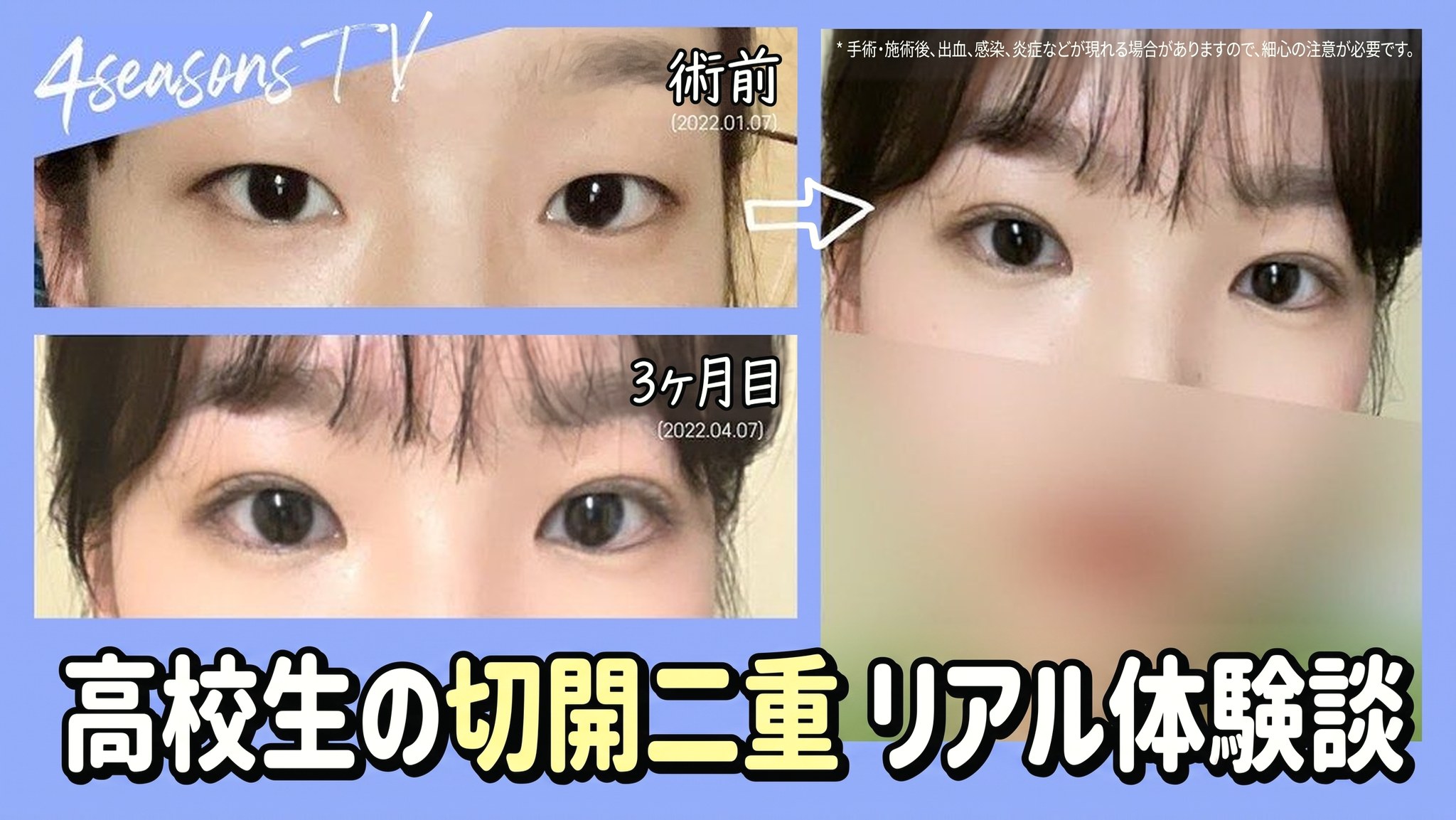 4seasonsTV 動画サムネイル - 高校生の切開二重 リアル体験談、術前(2022.01.07)と3か月後(2022.04.07)の目の比較