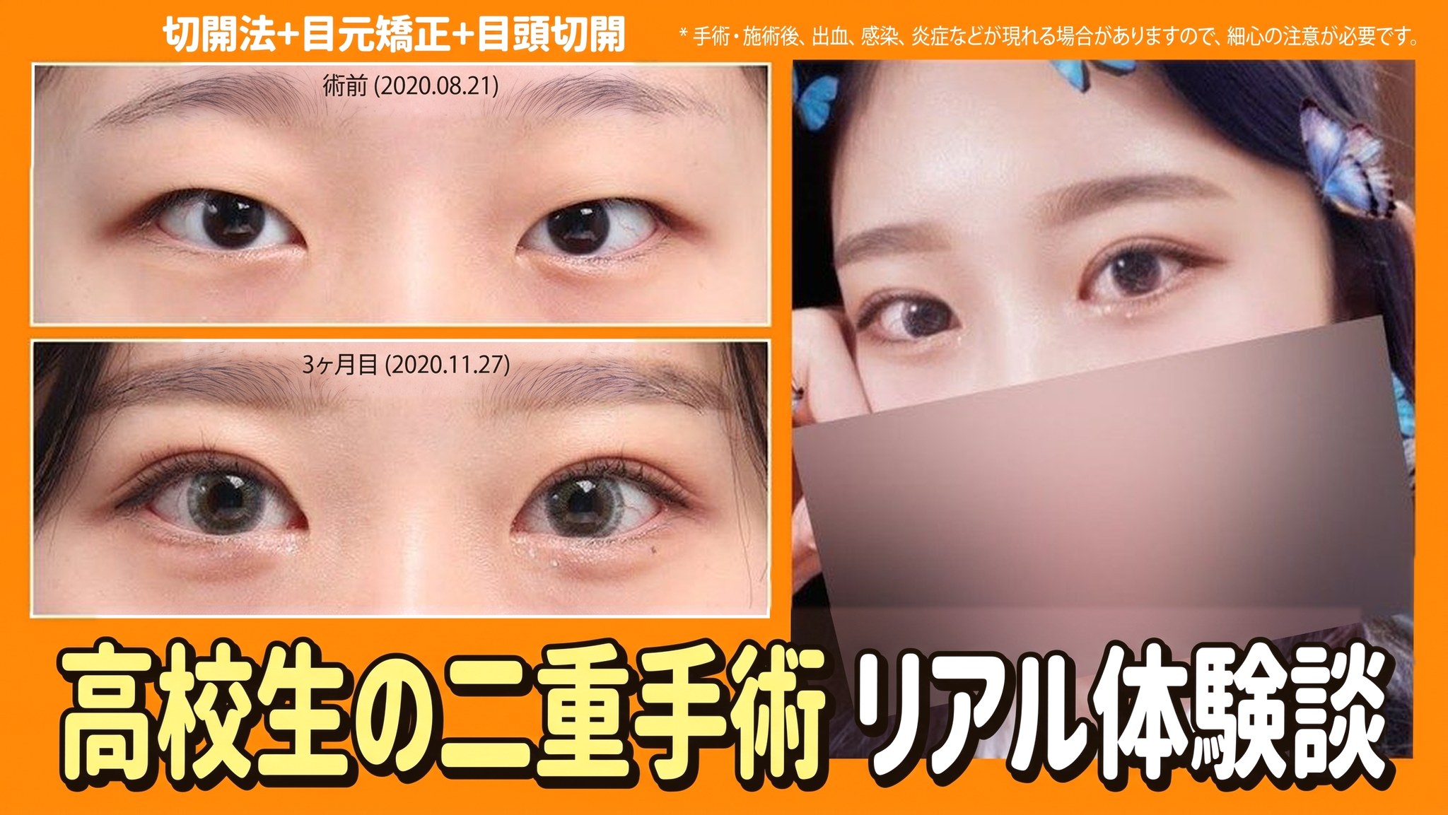 4seasonsTV 動画サムネイル - 高校生の二重手術 リアル体験談、切開+目元矯正+目頭切開、術前(2020.08.21)と3か月後(2020.11.27)の目の比較