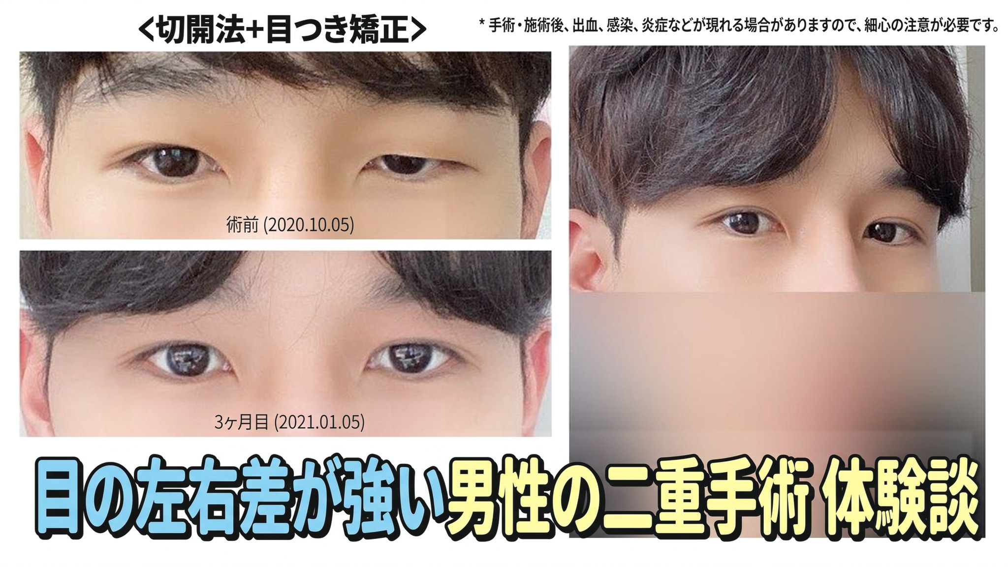4seasonsTV 動画サムネイル - 目の左右差が強い男性の二重手術体験談、切開+目元矯正、術前(2020.10.05)と3か月後(2021.01.05)の目の比較