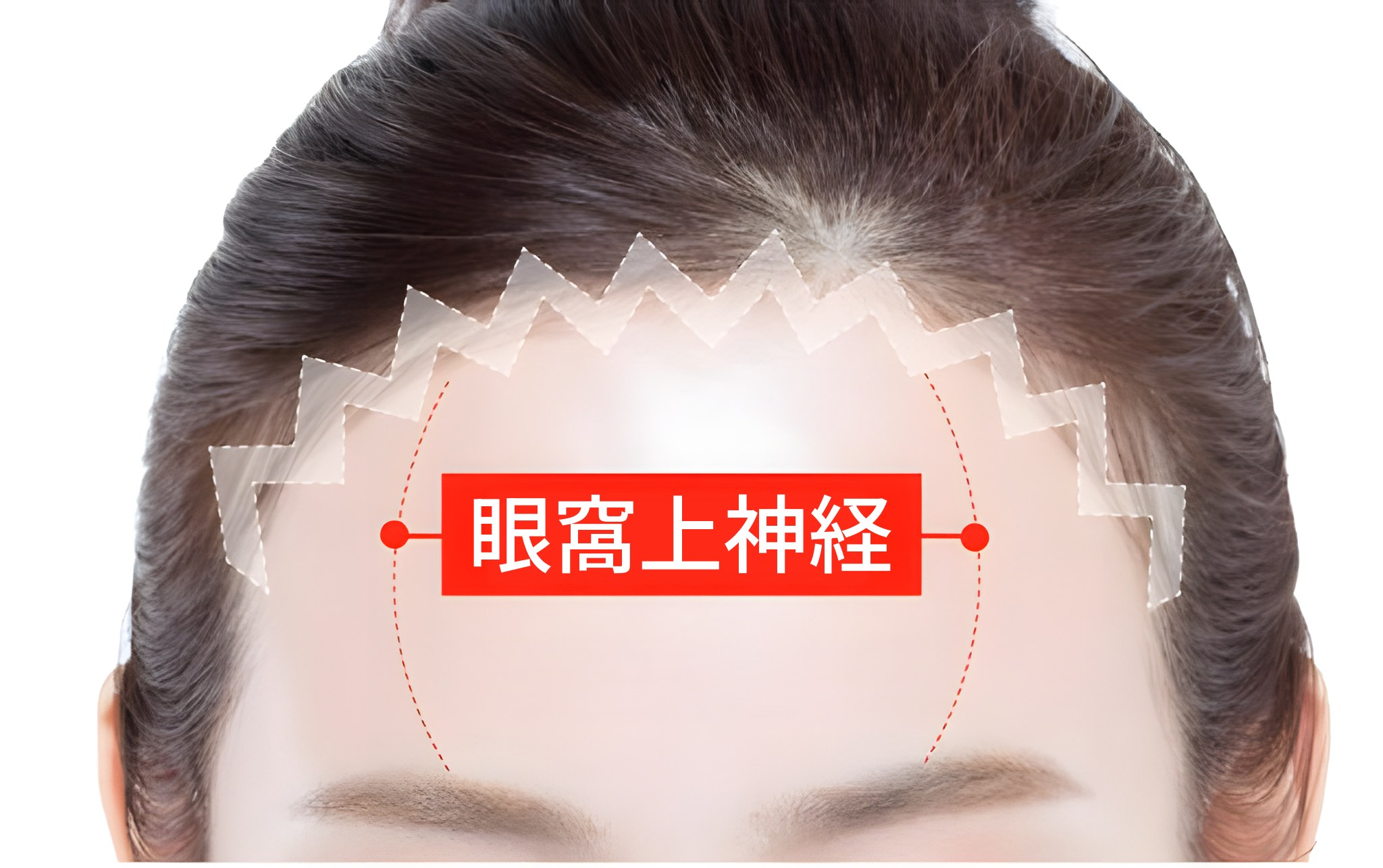 額の写真の上に眼窩上神経の位置を赤いラベルで示し、切開線を重ねて描いた図