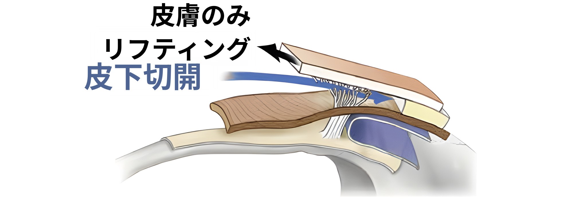 皮膚のみをリフティングした場合の断面図 — 矢印に「皮膚のみリフティング」、青い矢印に「皮下切開」と表示されている