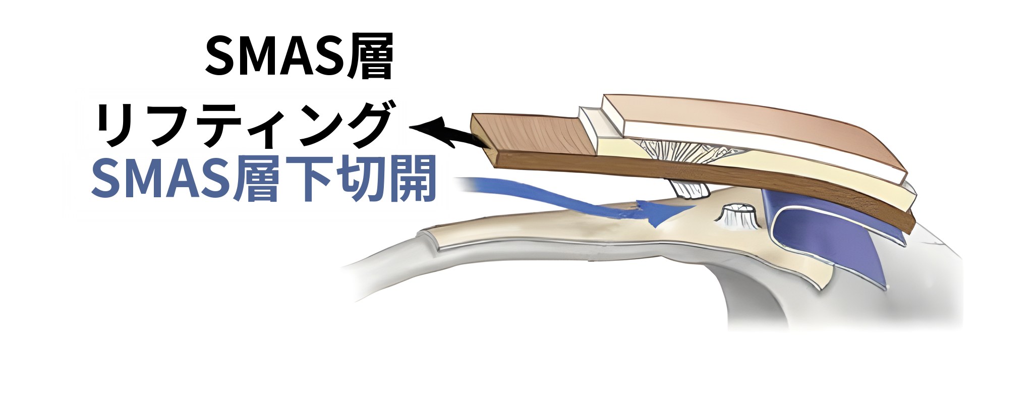 SMAS層までリフティングした場合の断面図 — 矢印に「SMAS層リフティング」、青い矢印に「SMAS層下切開」と表示されている