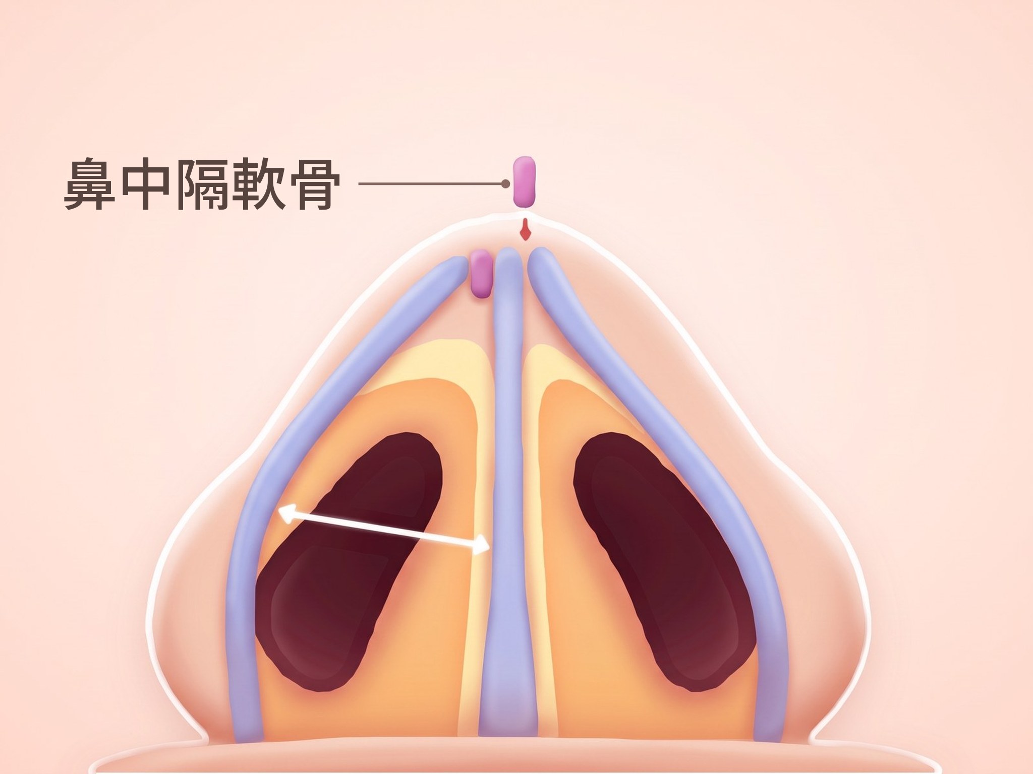 鼻中隔軟骨の移植片を入れた鼻の内部を下から見たイラスト