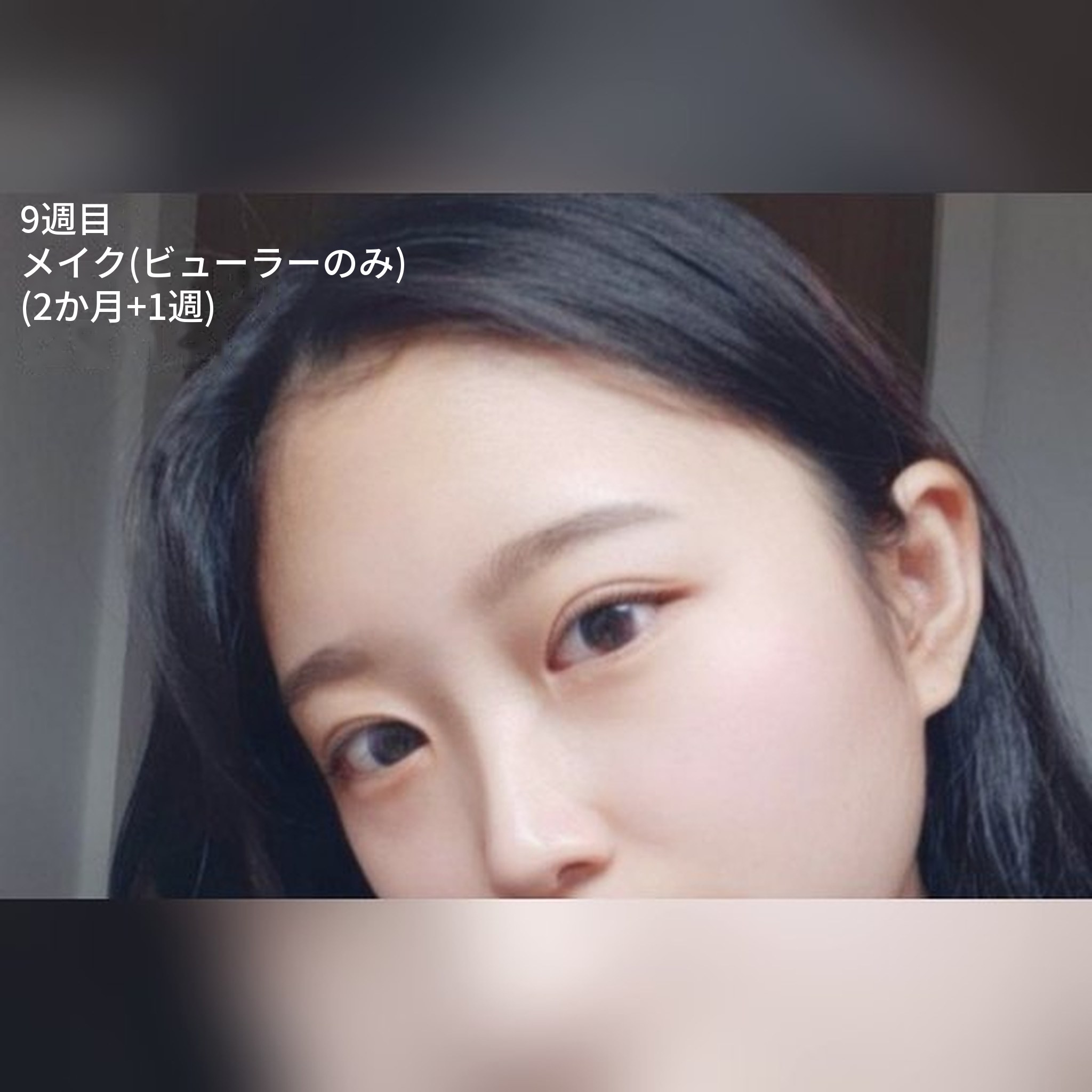 目整形の口コミ投稿サムネイル — インライン/目頭切開/眼瞼下垂矯正の口コミ