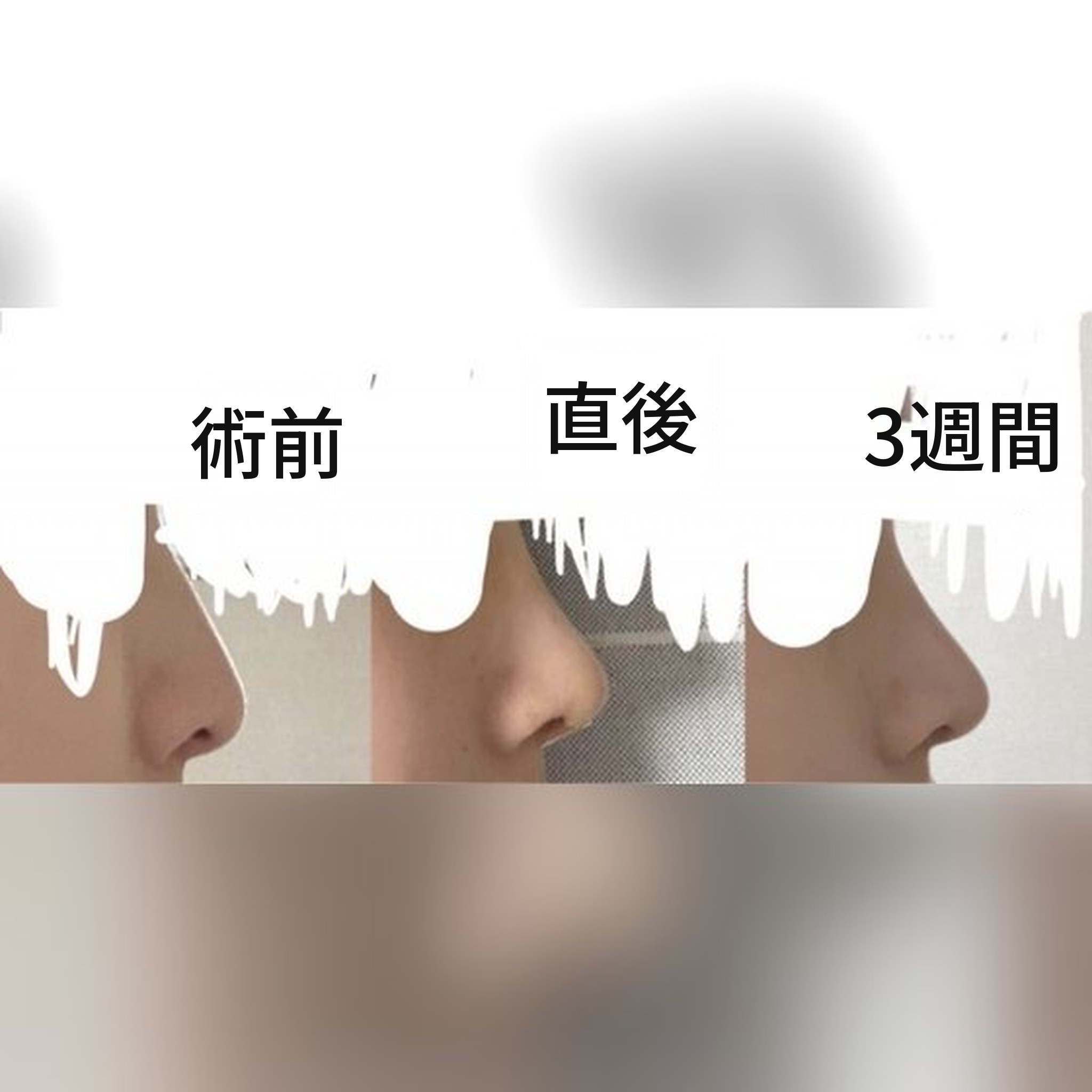 鼻整形の口コミ投稿サムネイル — Jegal Jeong⁠-⁠jae院長の鼻整形、おすすめです!!!^-^