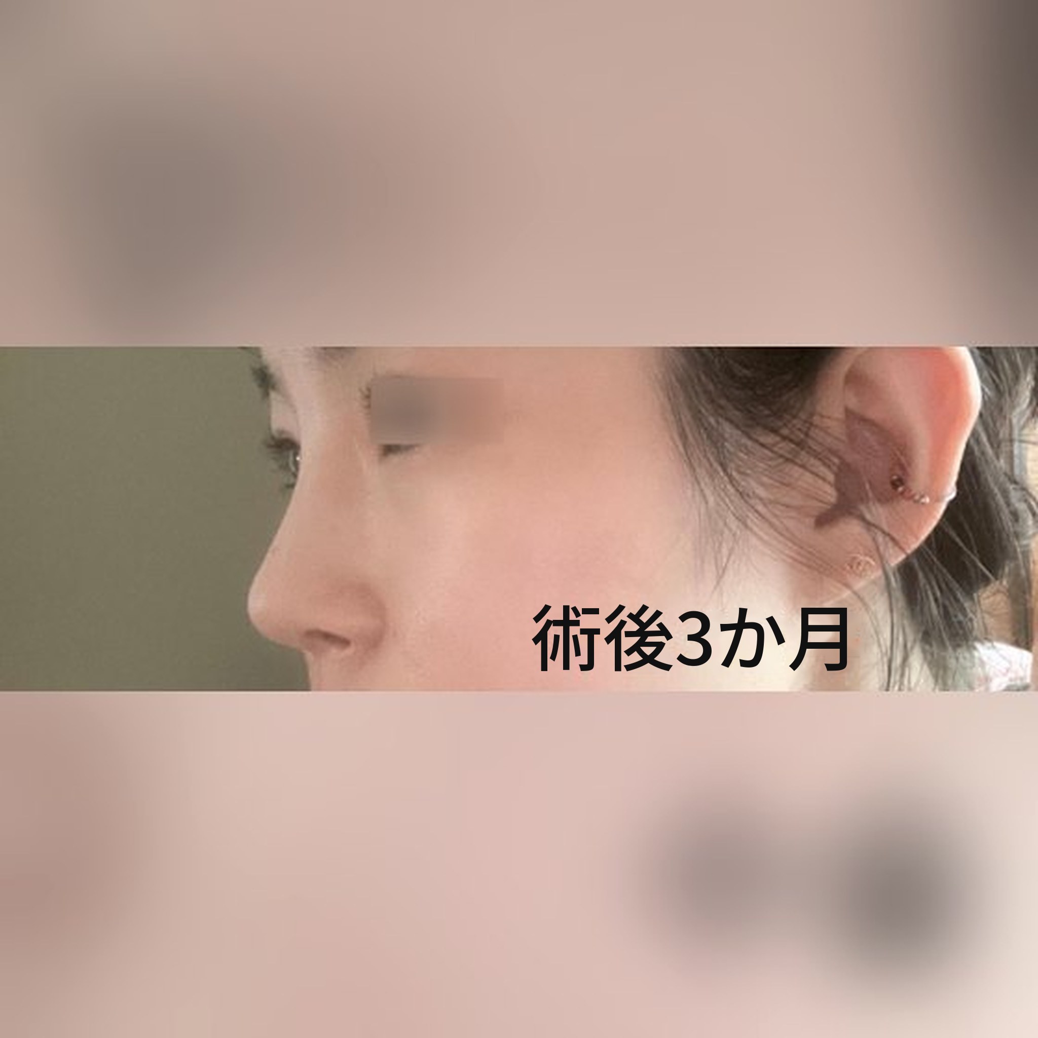 鼻整形の口コミ投稿のサムネイル — 大満足の鼻整形、3か月目です(笑)