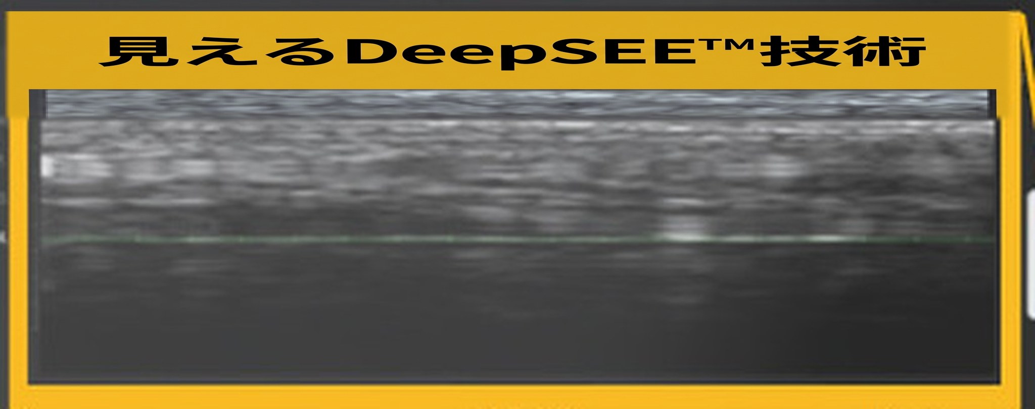 Ultherapy PRIME画面のDeepSEEコールアウト — リアルタイムの肌内部の超音波断面