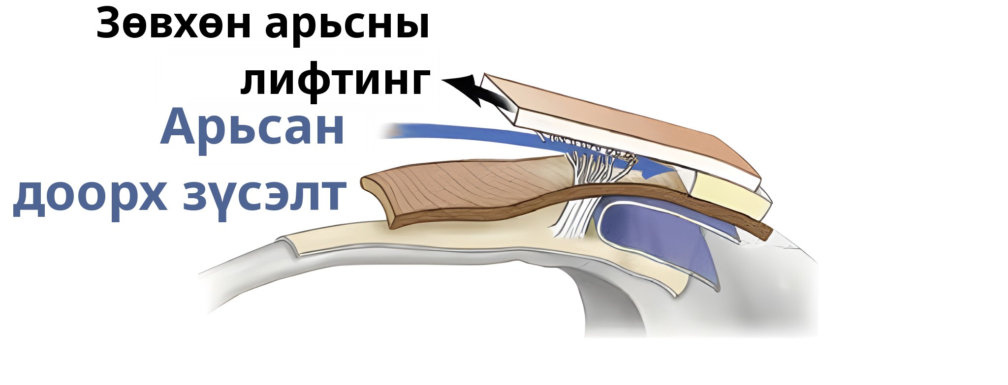 Зөвхөн арьсыг өргөсөн үеийн огтлолын схем — суман дээр «Зөвхөн арьс өргөх», цэнхэр суман дээр «Арьсан доорх зүсэлт» гэж тэмдэглэсэн