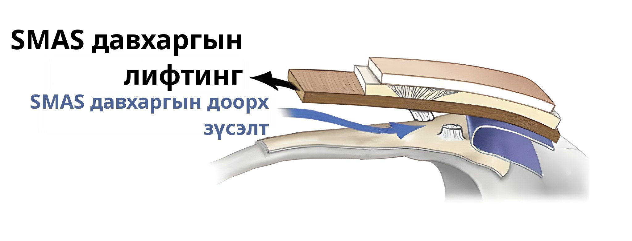 SMAS давхарга хүртэл өргөсөн үеийн огтлолын схем — суман дээр «SMAS давхарга өргөх», цэнхэр суман дээр «SMAS давхаргын доорх зүсэлт» гэж тэмдэглэсэн