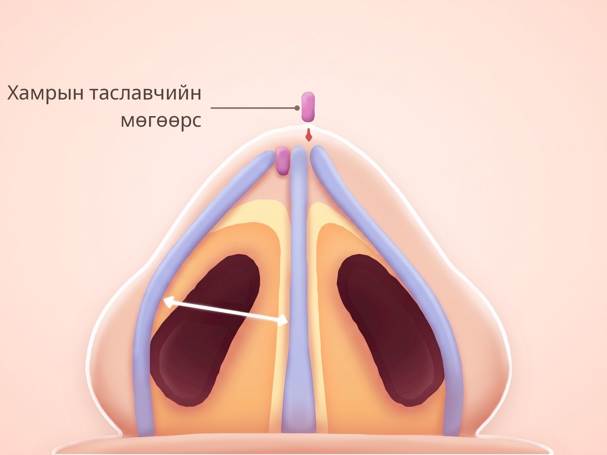 Таславчийн мөгөөрсний шилжүүлэг хийсэн хамрын дотрыг доороос харсан зураг