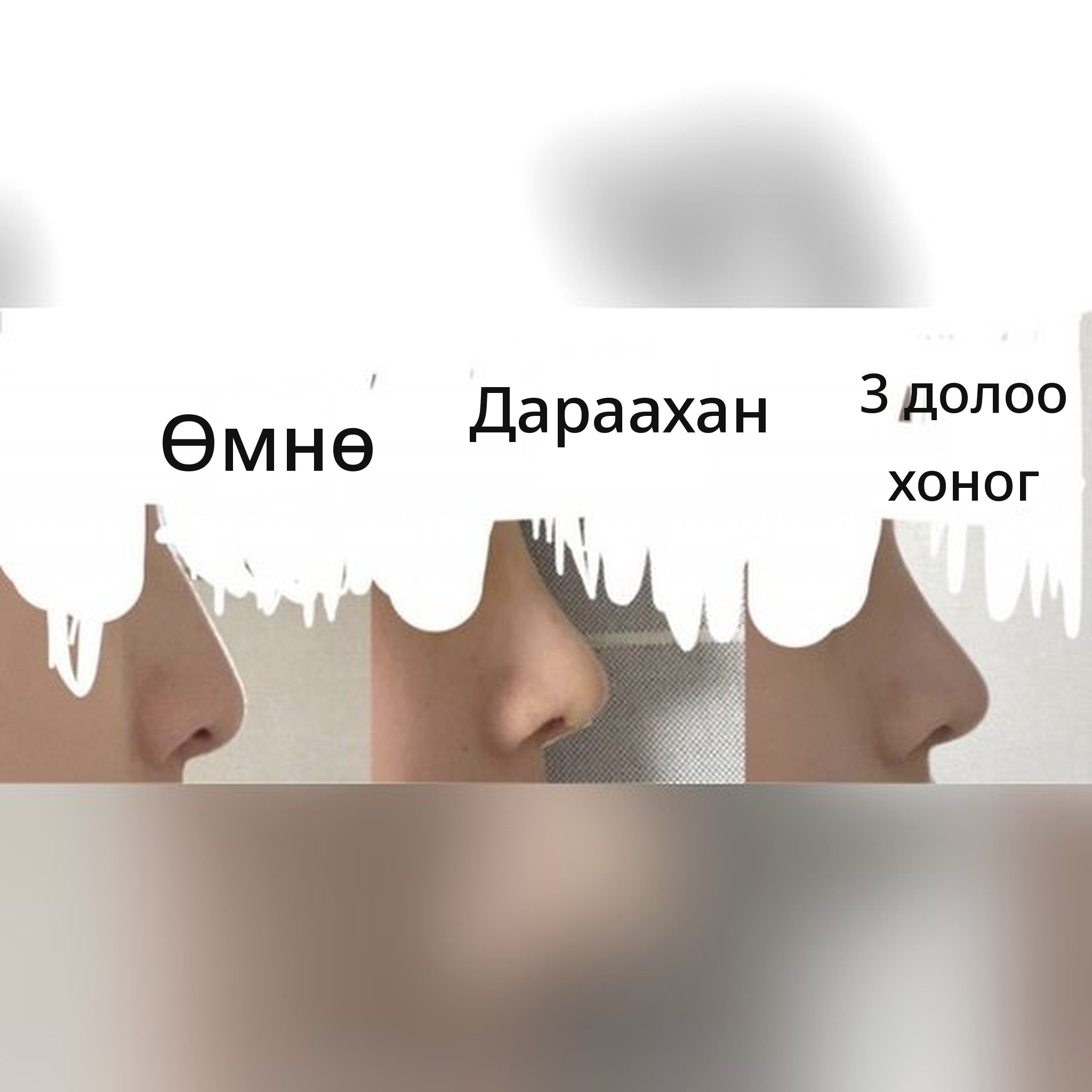 Хамрын хагалгааны сэтгэгдлийн нийтлэлийн зураг — Захирал эмч Jegal Jeong⁠-⁠jae-ийн хамрын хагалгааг санал болгоё!!!^-^