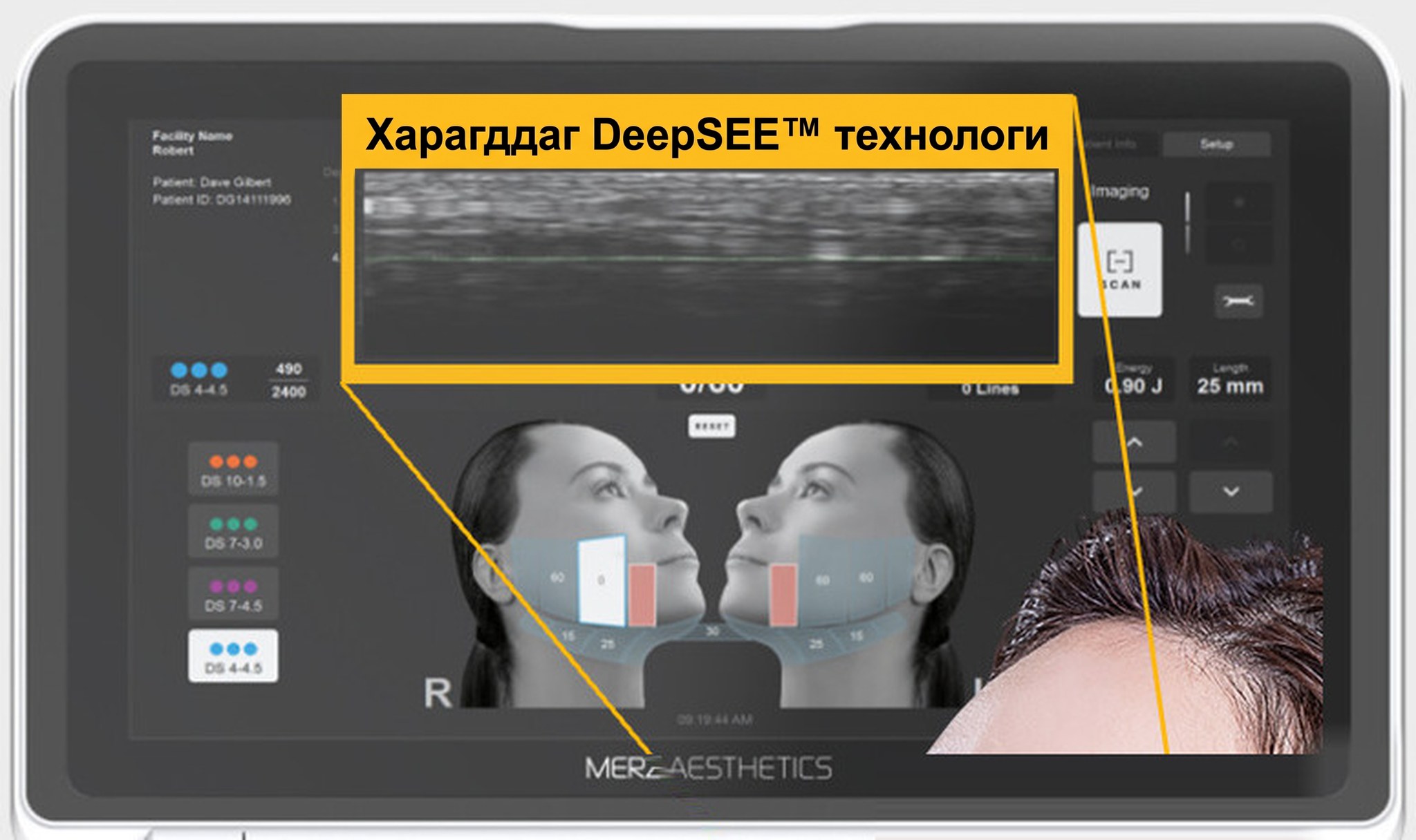 Ultherapy PRIME монитор — дөрвөн талын хүрээ харагдаж буй төхөөрөмжийн дэлгэц
