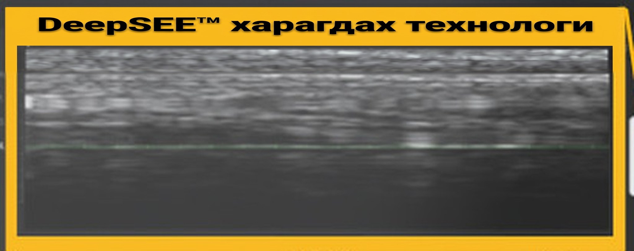 Ultherapy PRIME дэлгэцийн DeepSEE тайлбар — арьсны доторх хэт авианы бодит цагийн огтлол