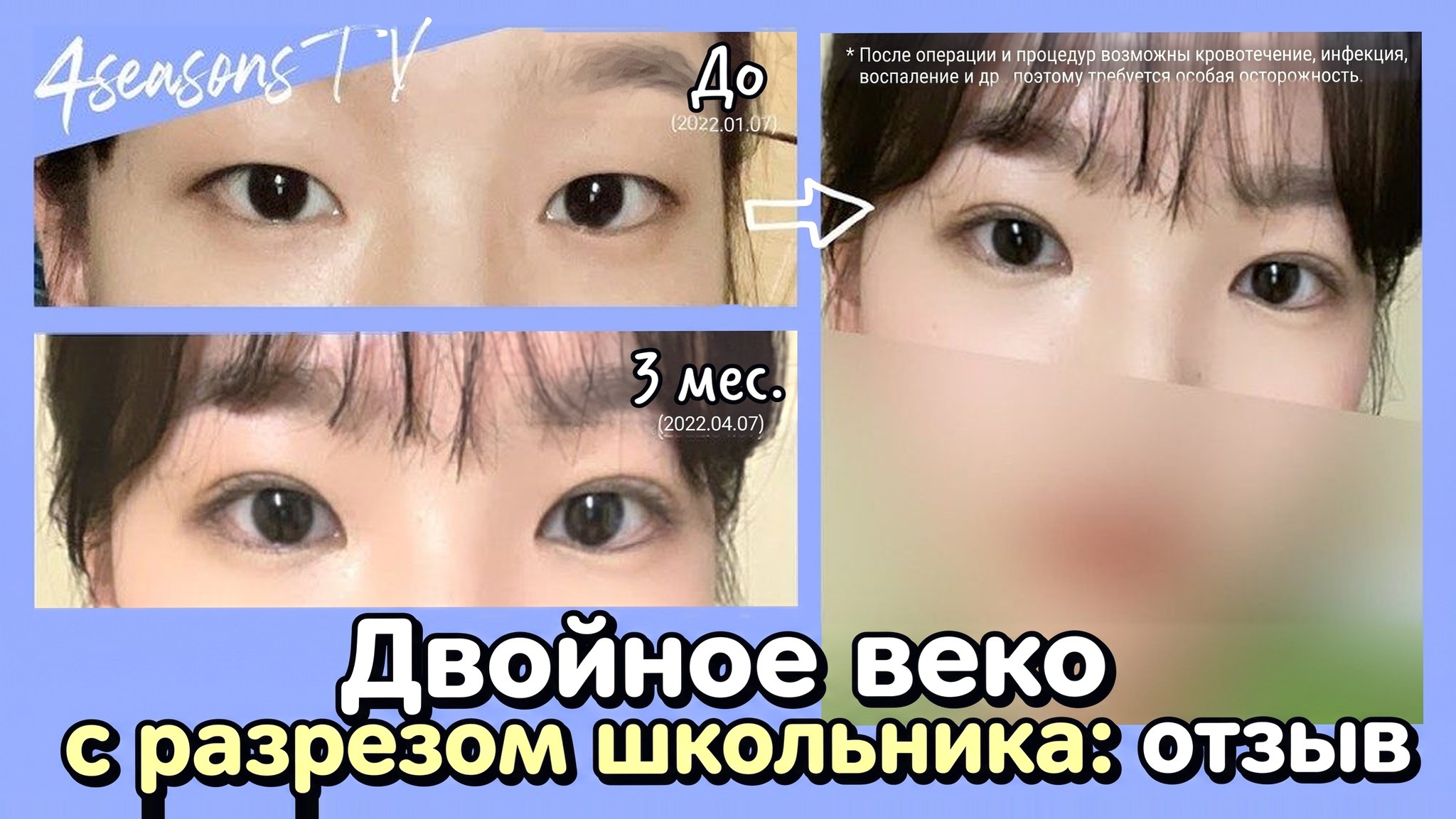 Миниатюра видео 4seasonsTV — Реальный отзыв: двойное веко с разрезом в старших классах, сравнение глаз до операции (2022.01.07) и через 3 месяца (2022.04.07)