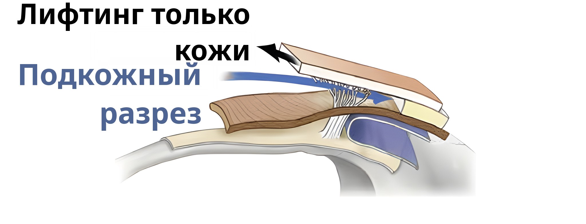 Схема разреза при подтяжке только кожи — на стрелке подпись «Подтяжка только кожи», на синей стрелке — «Подкожный разрез»