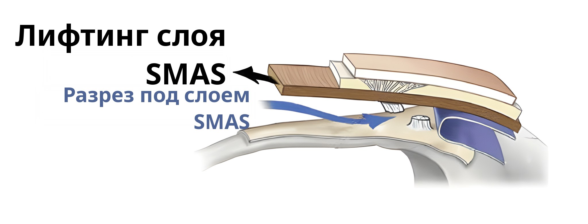 Схема разреза при подтяжке вплоть до слоя SMAS — на стрелке подпись «Подтяжка слоя SMAS», на синей стрелке — «Разрез под слоем SMAS»
