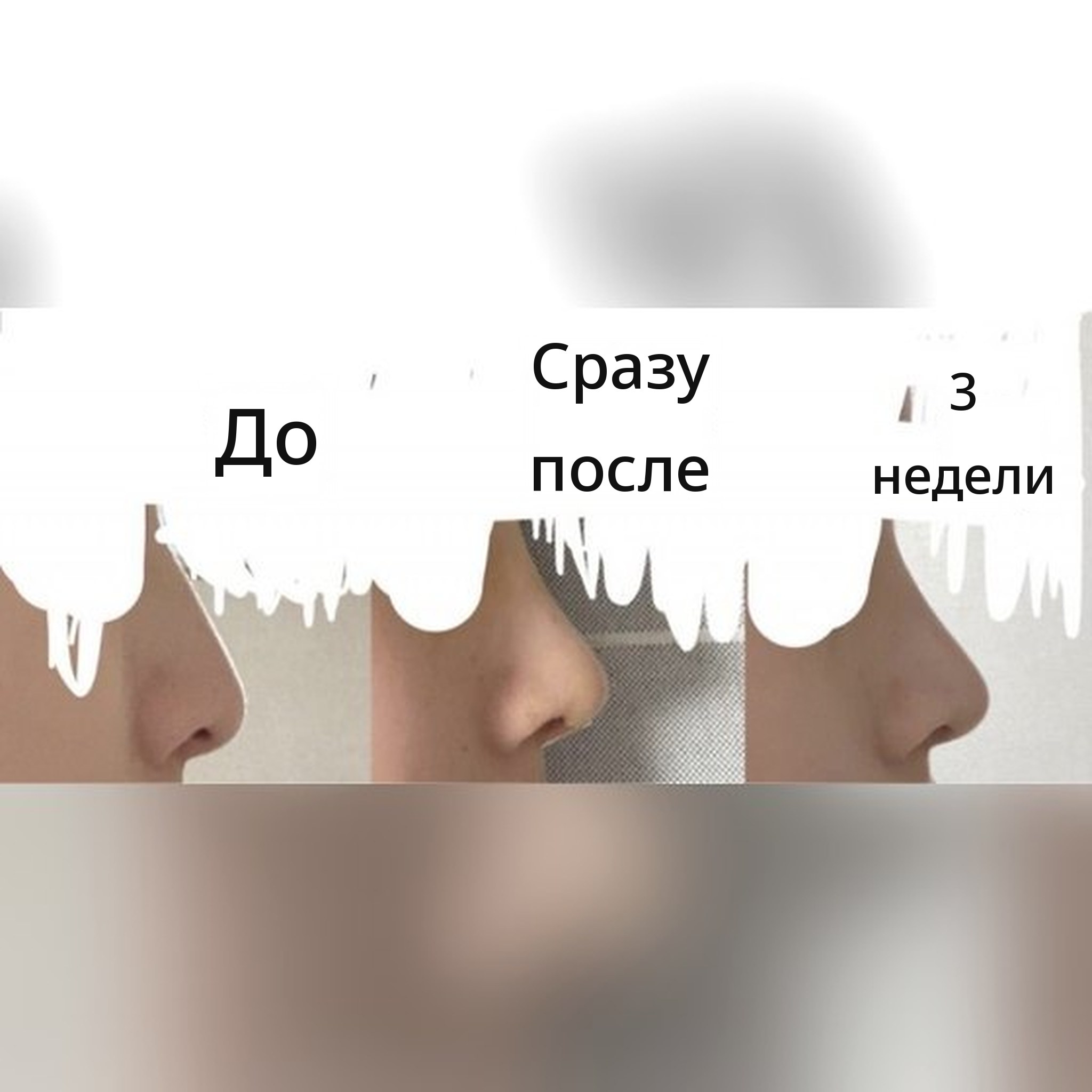 Миниатюра отзыва о ринопластике — Рекомендую ринопластику у главного врача Jegal Jeong⁠-⁠jae!!!^-^