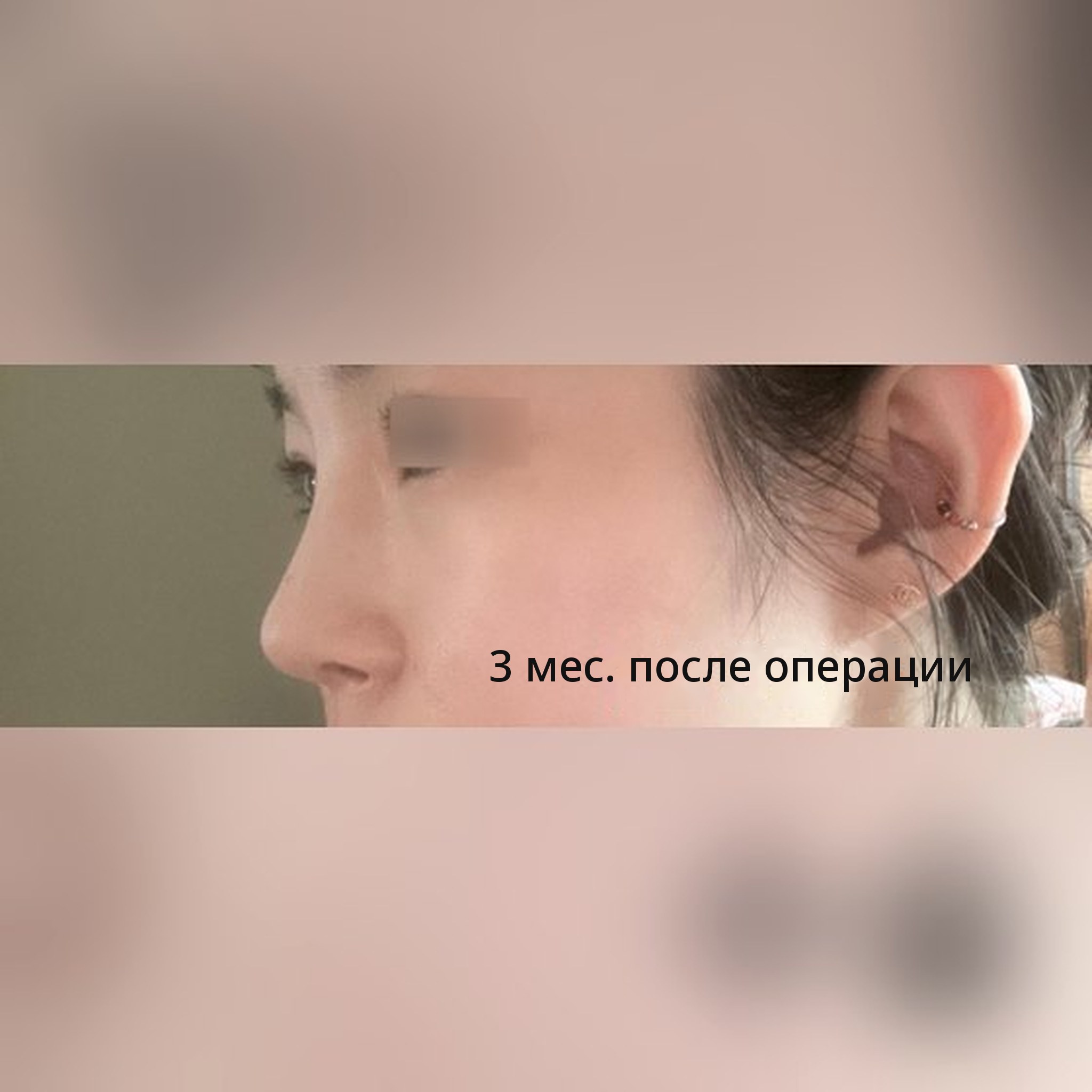 Миниатюра отзыва о ринопластике — Ринопластика, 3 месяца после операции: результат полностью устраивает!