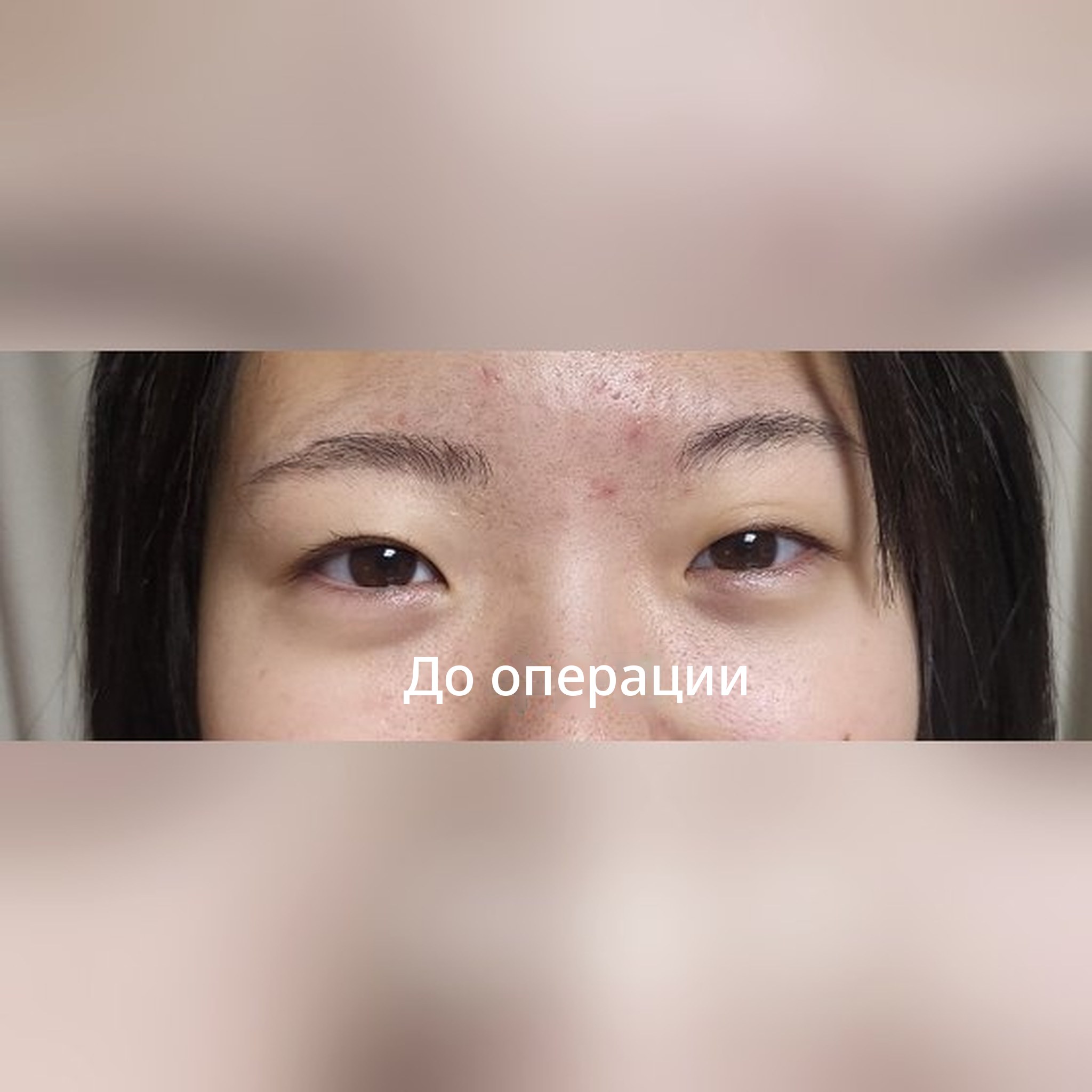 Превью поста с отзывом о пластике глаз — Оставляю отзыв об операции на двойное веко у дочери-старшеклассницы~~