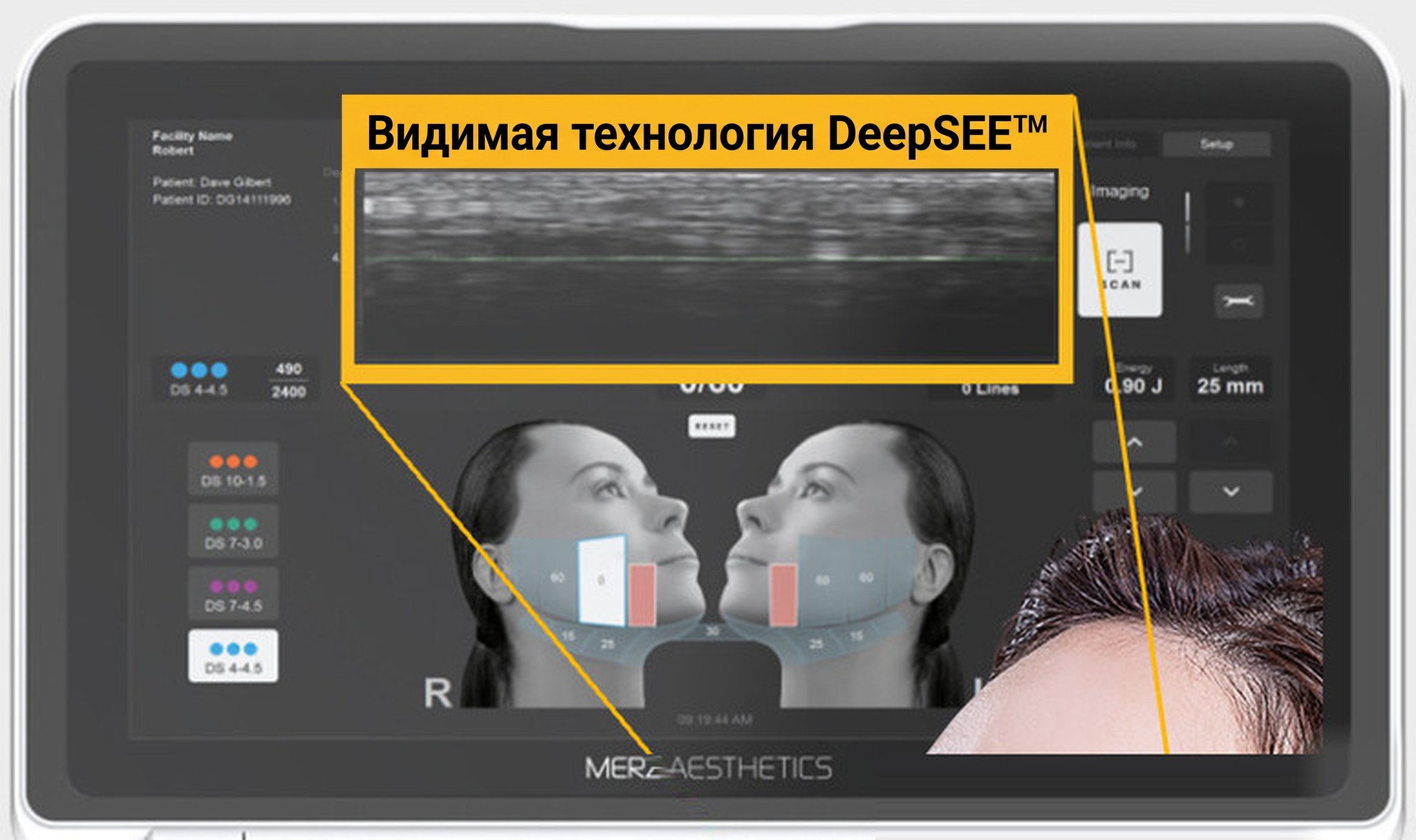 Монитор Ultherapy PRIME — экран аппарата с видимой рамкой по четырём сторонам