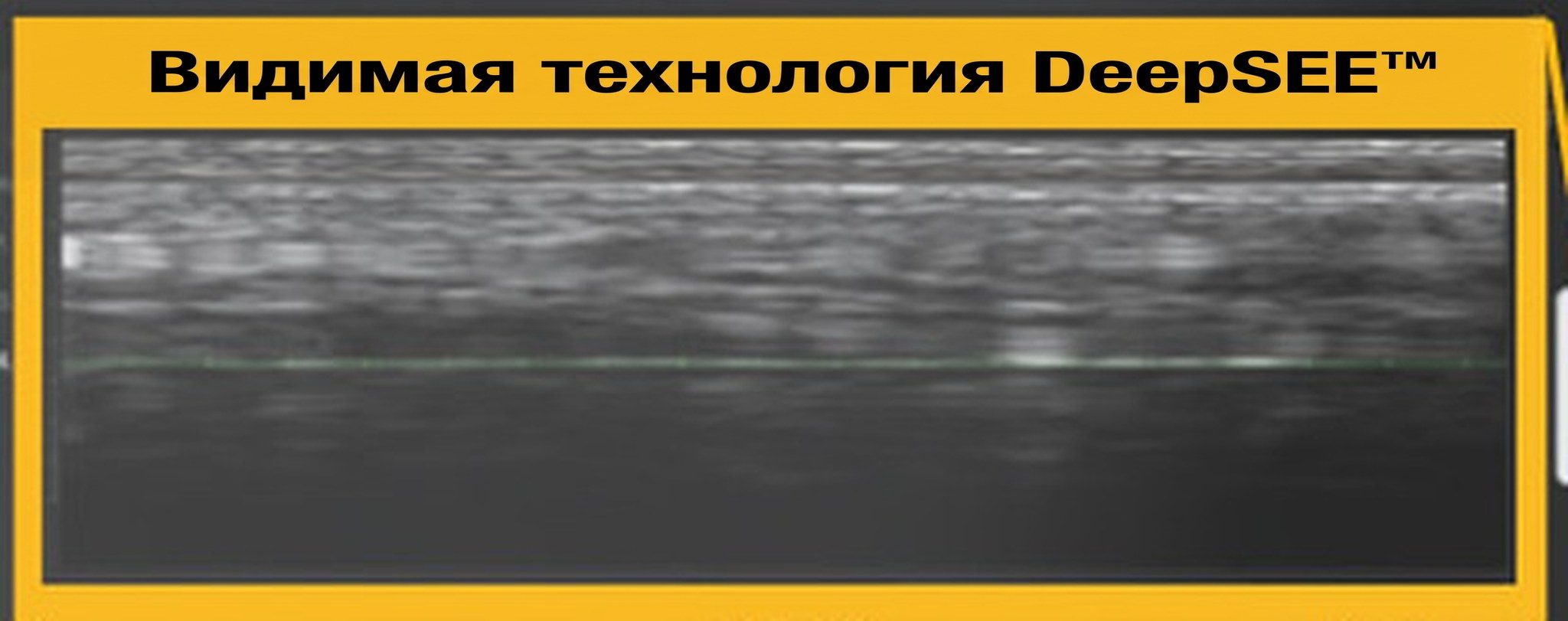 Выноска DeepSEE на экране Ultherapy PRIME — ультразвуковой срез тканей под кожей в реальном времени
