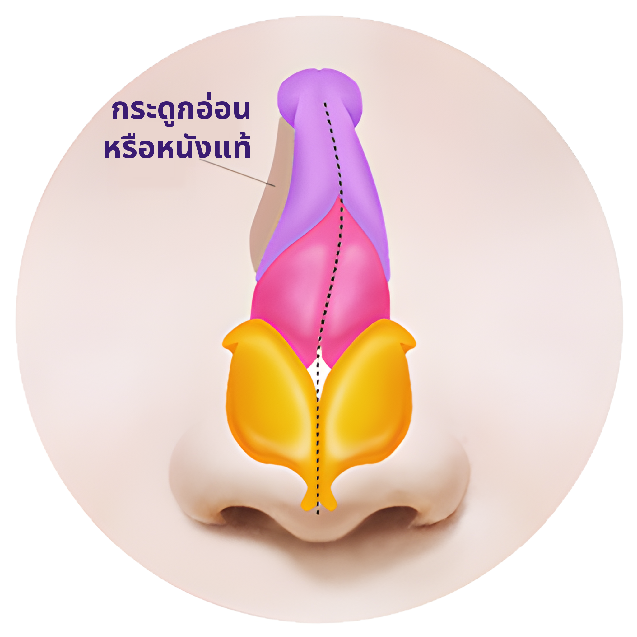 ภาพประกอบภาคตัดด้านหน้าของจมูกที่ปลูกถ่ายกระดูกอ่อนหรือหนังแท้เข้าไปเติมส่วนที่บุ๋ม