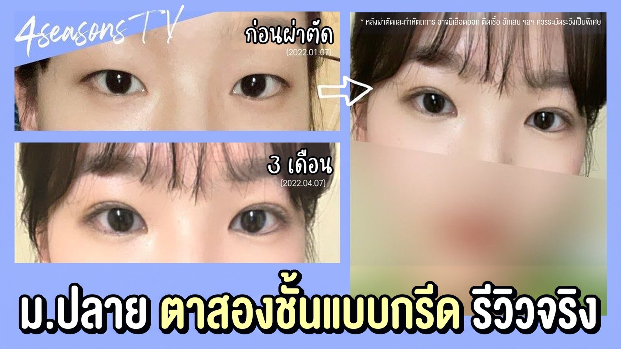 ภาพขนาดย่อวิดีโอ 4seasonsTV - รีวิวจริงการทำตาสองชั้นแบบผ่าของนักเรียนมัธยมปลาย, เปรียบเทียบดวงตาก่อนผ่าตัด (2022.01.07) และหลังผ่าตัด 3 เดือน (2022.04.07)