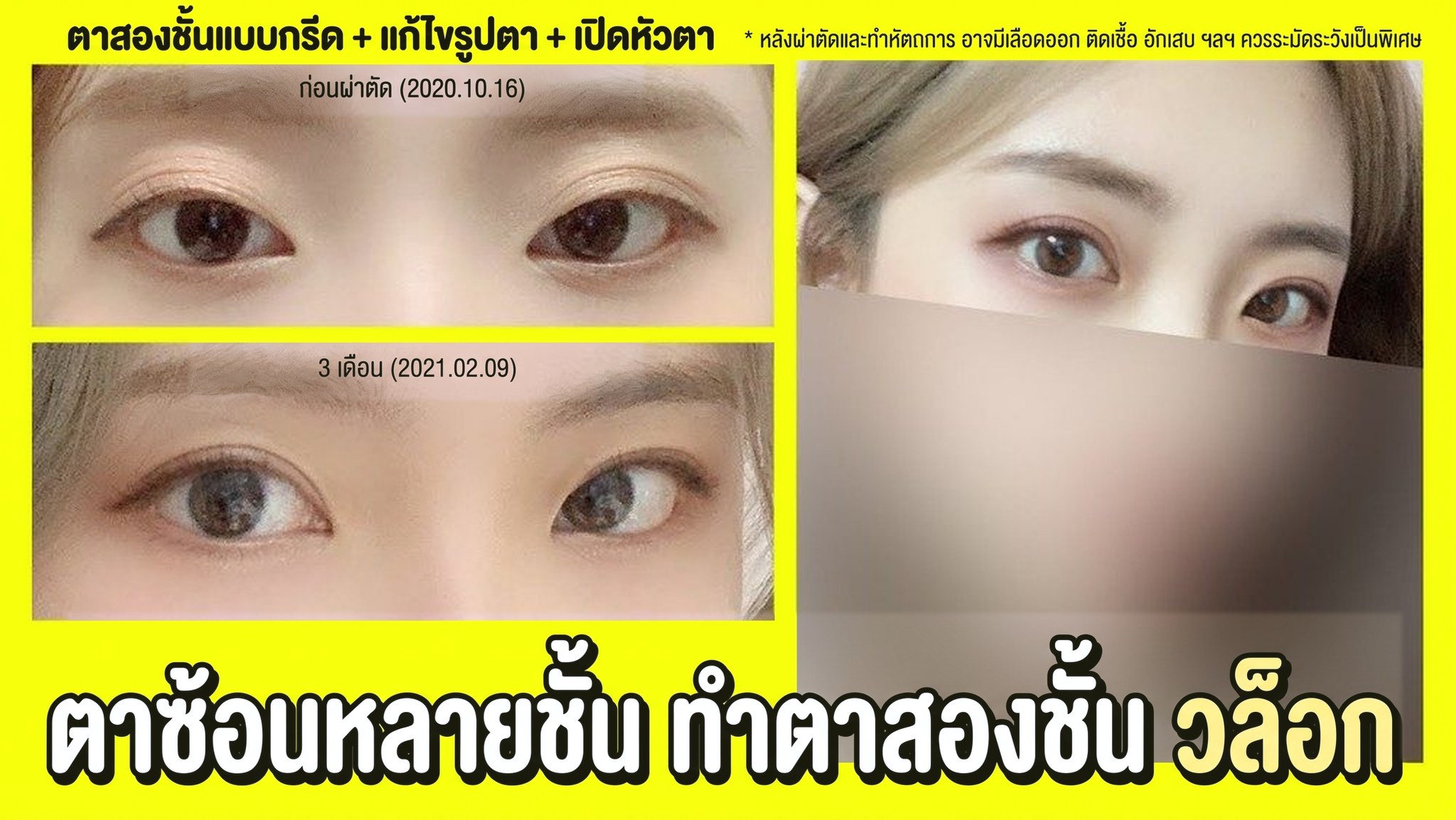 ภาพขนาดย่อวิดีโอ 4seasonsTV - วล็อกการทำตาสองชั้นสำหรับผู้ที่มีเส้นตาซ้อนหลายชั้น, ผ่าตัดตาสองชั้น+แก้ไขแนวดวงตา+เปิดหัวตา, เปรียบเทียบดวงตาก่อนผ่าตัด (2020.10.16) และหลังผ่าตัด 3 เดือน (2021.02.09)