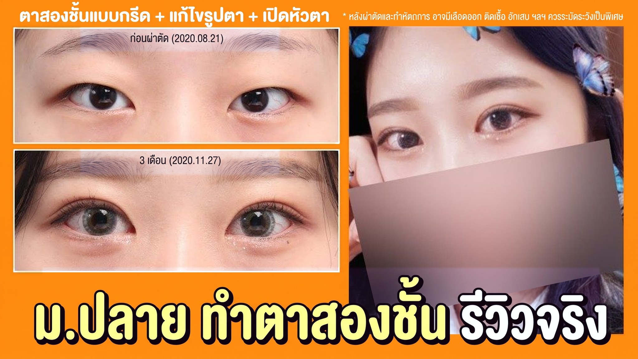 ภาพขนาดย่อวิดีโอ 4seasonsTV - รีวิวจริงการทำตาสองชั้นของนักเรียนมัธยมปลาย, ผ่าตัดตาสองชั้น+แก้ไขแนวดวงตา+เปิดหัวตา, เปรียบเทียบดวงตาก่อนผ่าตัด (2020.08.21) และหลังผ่าตัด 3 เดือน (2020.11.27)