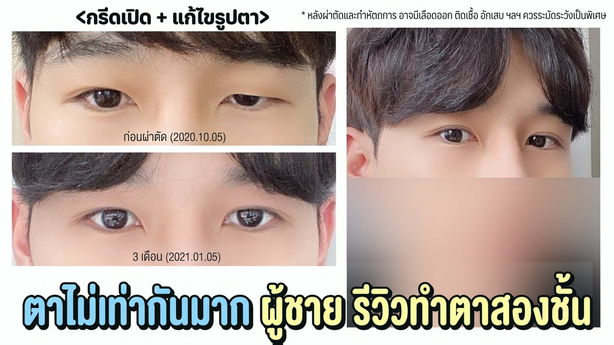 ภาพขนาดย่อวิดีโอ 4seasonsTV - รีวิวการทำตาสองชั้นของผู้ชายที่ตาสองข้างไม่เท่ากันมาก, ผ่าตัดตาสองชั้น+แก้ไขแนวดวงตา, เปรียบเทียบดวงตาก่อนผ่าตัด (2020.10.05) และหลังผ่าตัด 3 เดือน (2021.01.05)