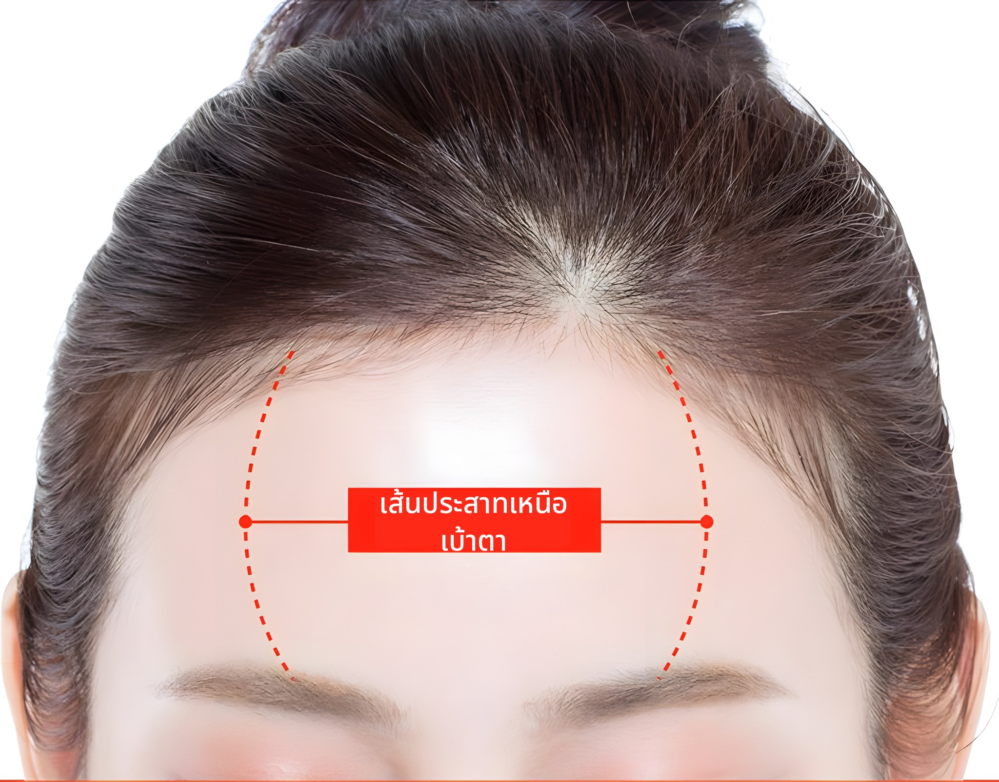 ภาพประกอบที่แสดงช่วงที่เส้นประสาทซูพราออร์บิทัล (Supraorbital nerve) พาดผ่านบนภาพหน้าผากด้วยเส้นประสีแดงและป้ายกำกับ