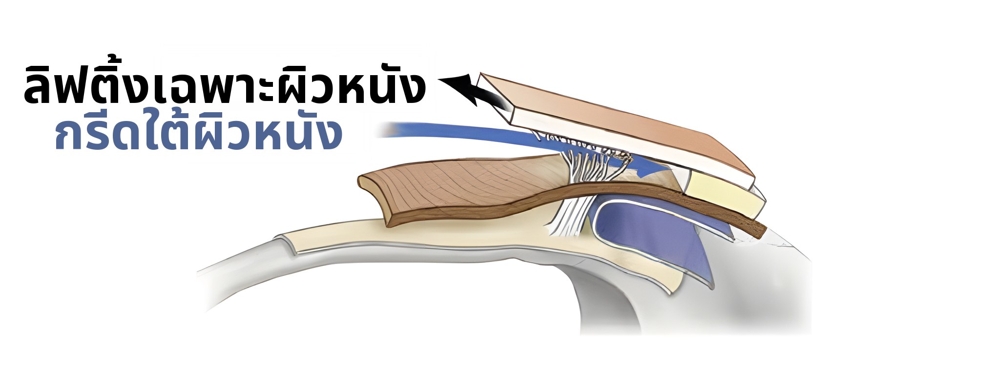 ภาพตัดขวางเมื่อยกกระชับเฉพาะผิวหนัง — ลูกศรระบุว่า ‘ยกกระชับเฉพาะผิวหนัง’ และลูกศรสีน้ำเงินระบุว่า ‘กรีดใต้ผิวหนัง’