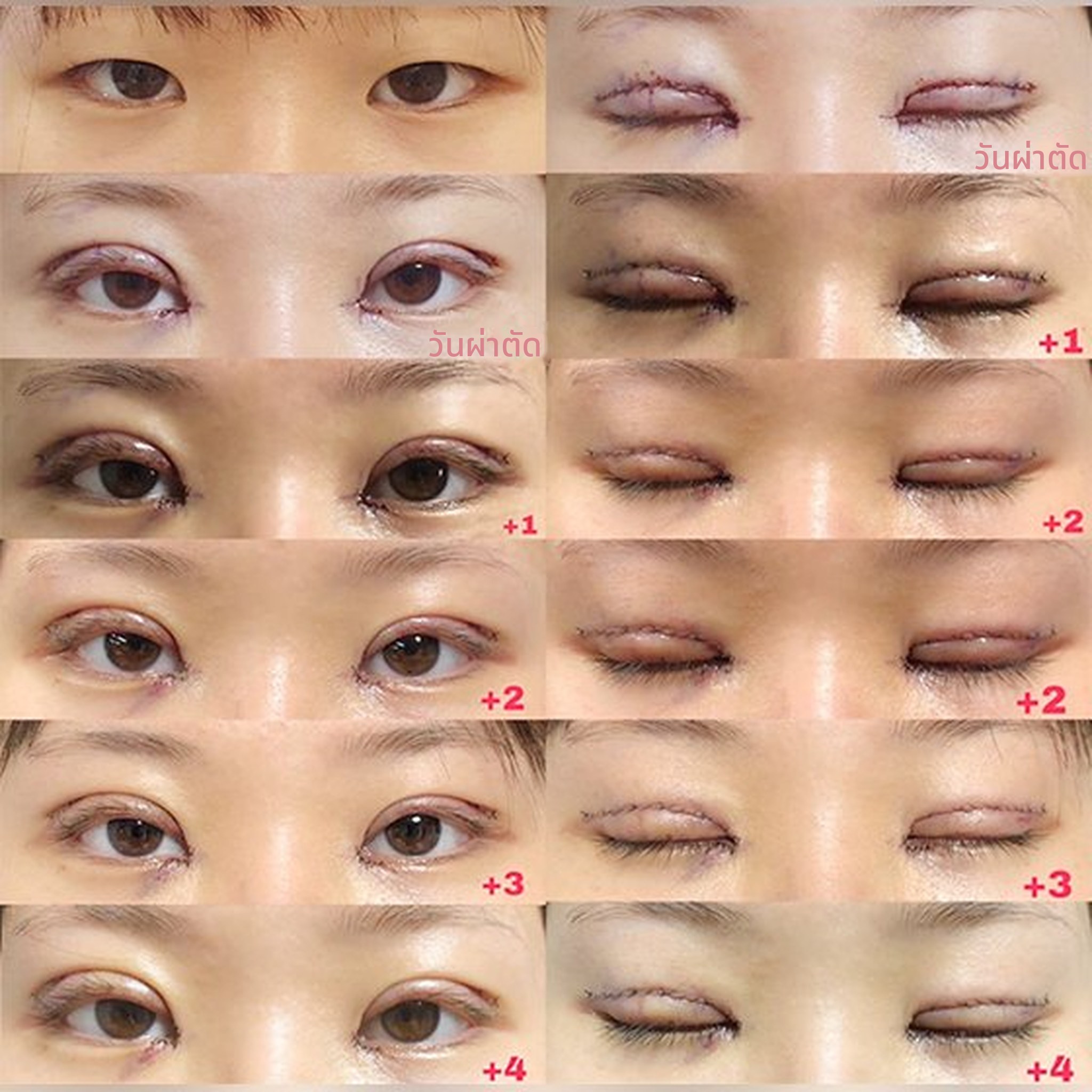 ภาพปกโพสต์รีวิวศัลยกรรมตา — รีวิวทำตาสองชั้น ตั้งแต่วันผ่าตัดจนถึงสัปดาห์ที่ 2