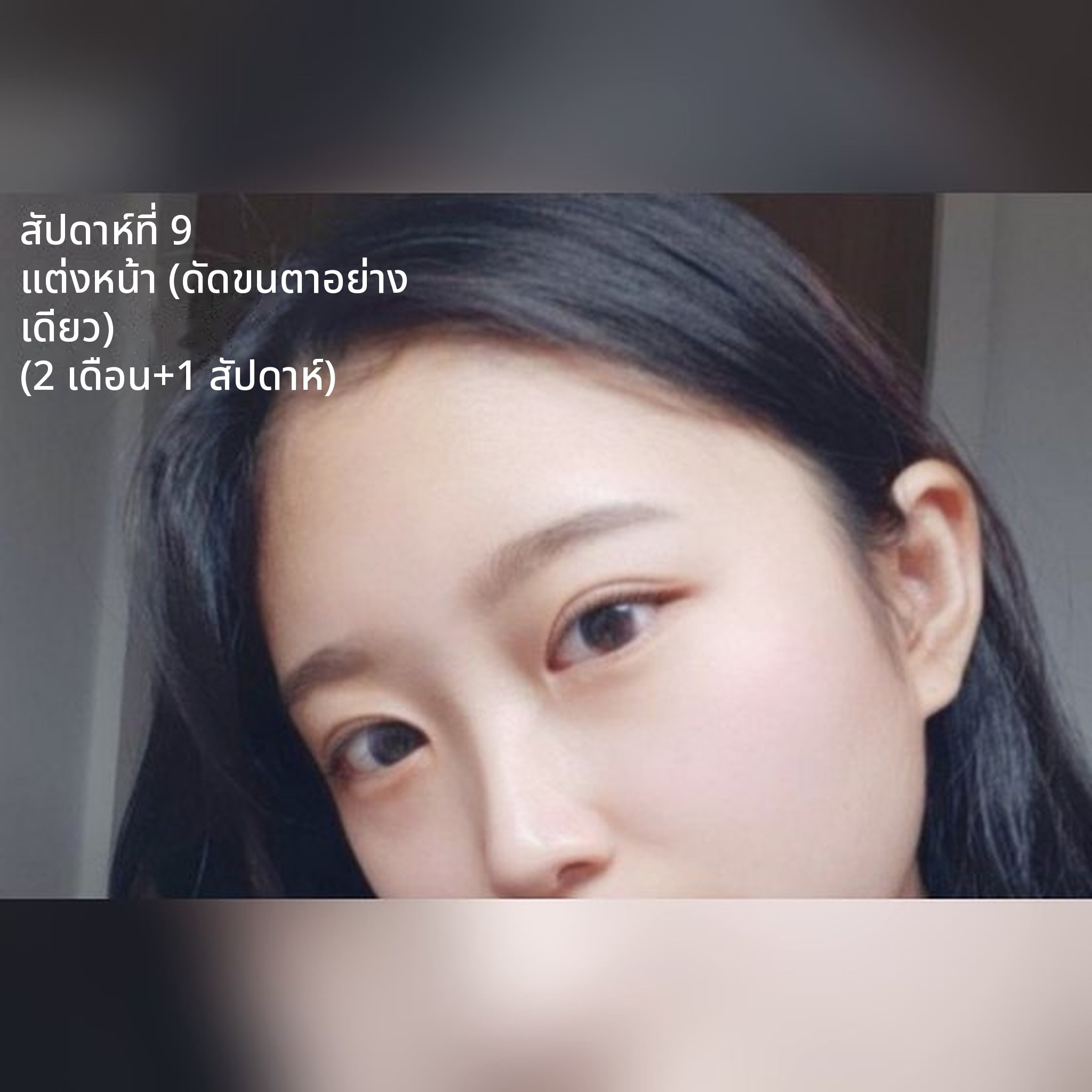 ภาพปกโพสต์รีวิวศัลยกรรมตา — รีวิวตาสองชั้นแบบอินไลน์/เปิดหัวตา/​ปรับรูปตา