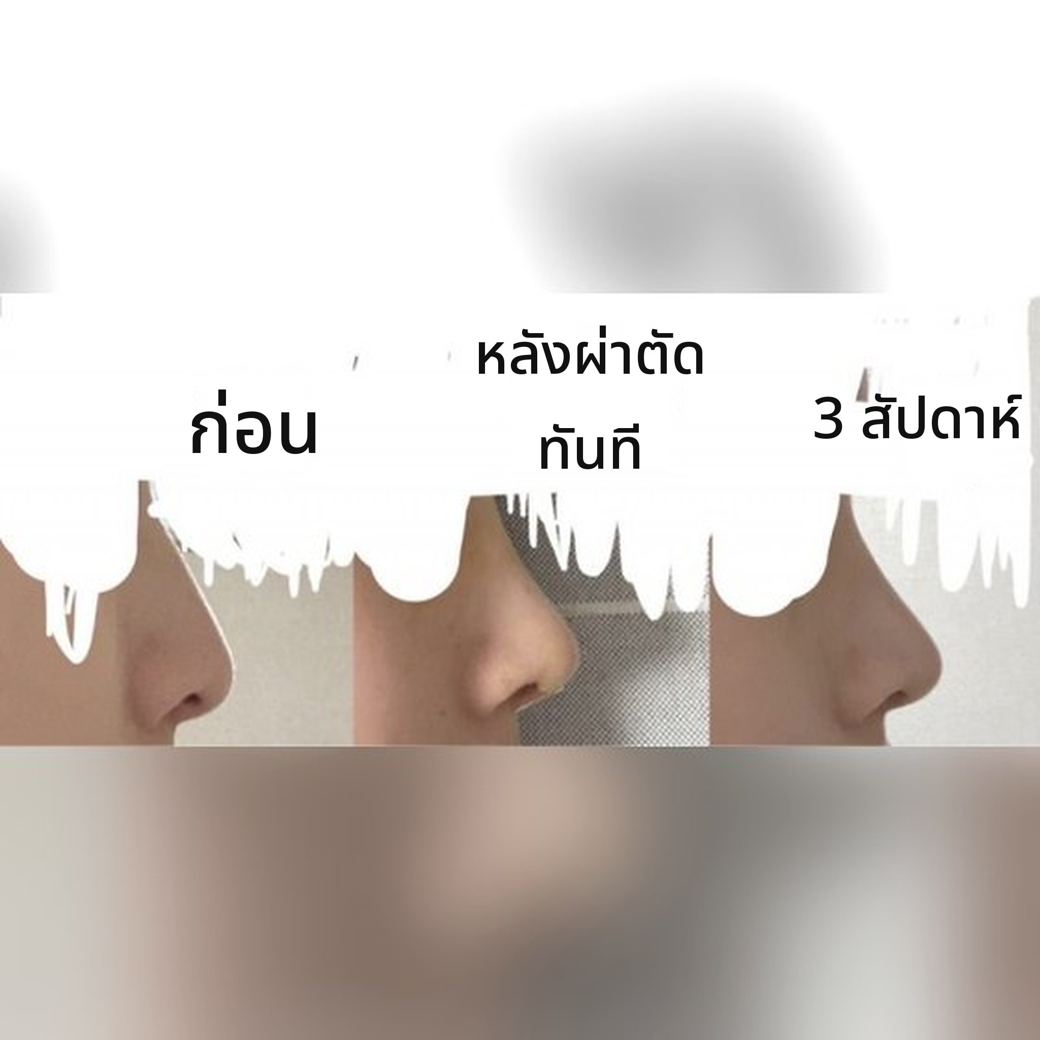 ภาพปกโพสต์รีวิวศัลยกรรมจมูก — แนะนำศัลยกรรมจมูกกับคุณหมอ Jegal Jeong⁠-⁠jae เลย!!!^-^