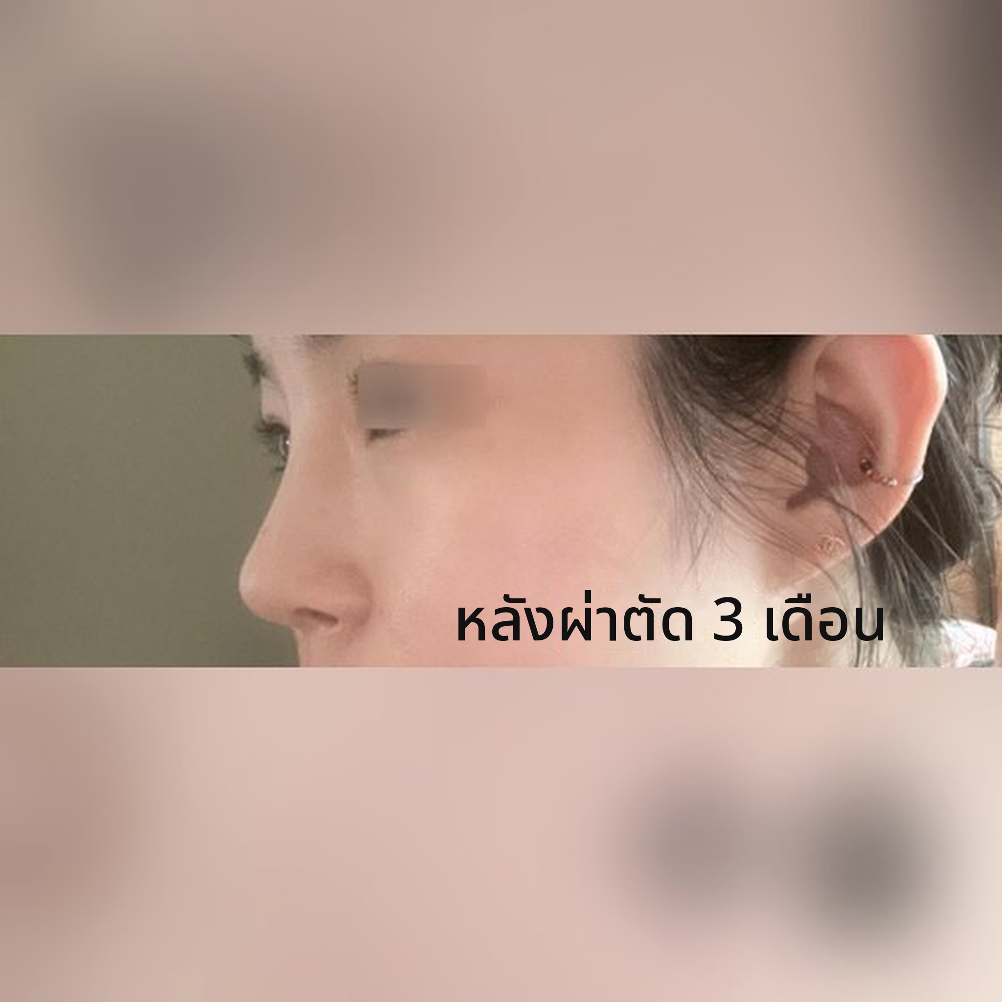 ภาพปกโพสต์รีวิวศัลยกรรมจมูก — ศัลยกรรมจมูกครบ 3 เดือน พอใจสุดๆ 555