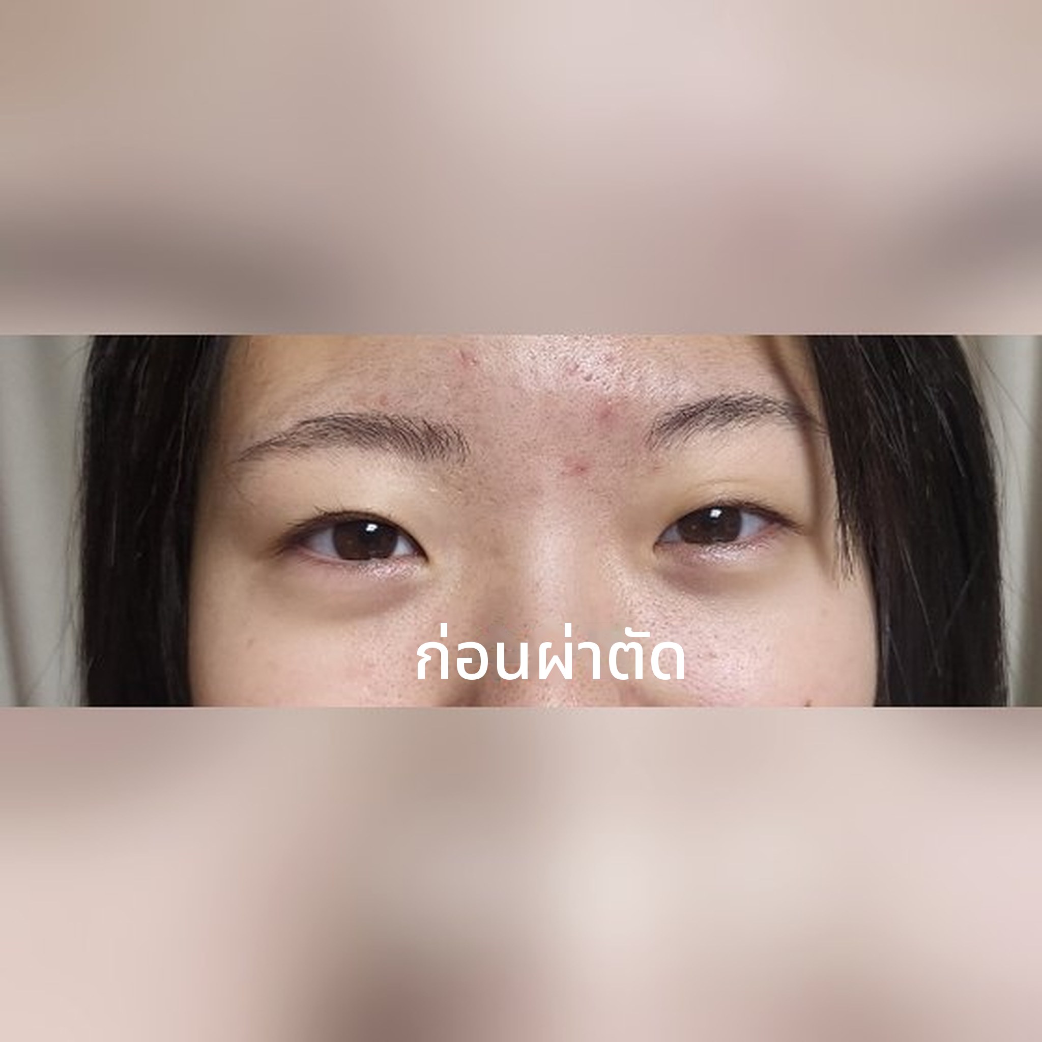 ภาพปกโพสต์รีวิวศัลยกรรมตา — ขอเขียนรีวิวทำตาสองชั้นของลูกสาวมัธยมปลาย~~