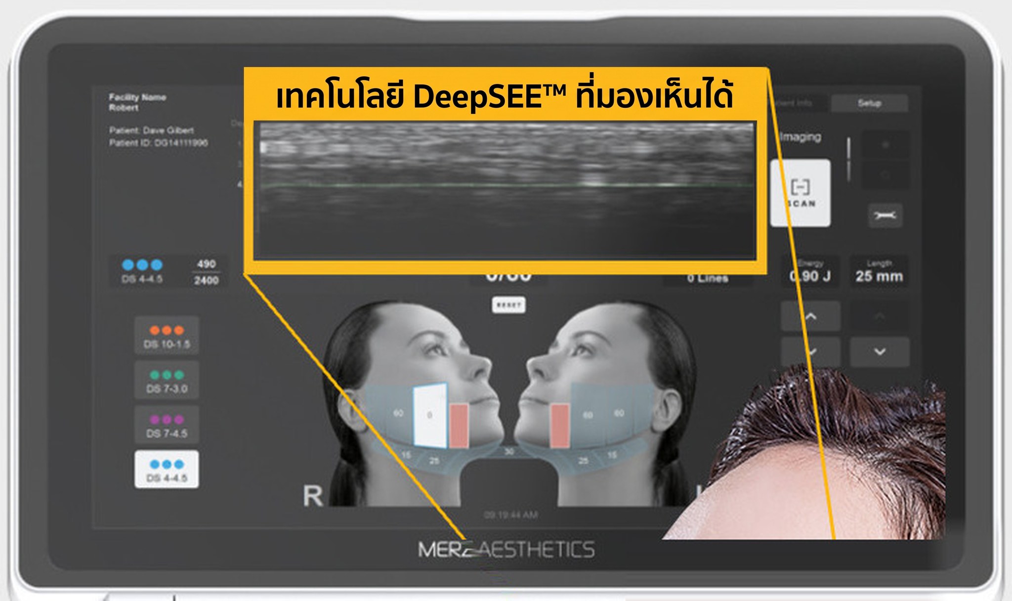 จอมอนิเตอร์ Ultherapy PRIME — หน้าจออุปกรณ์ที่เห็นขอบจอทั้งสี่ด้าน