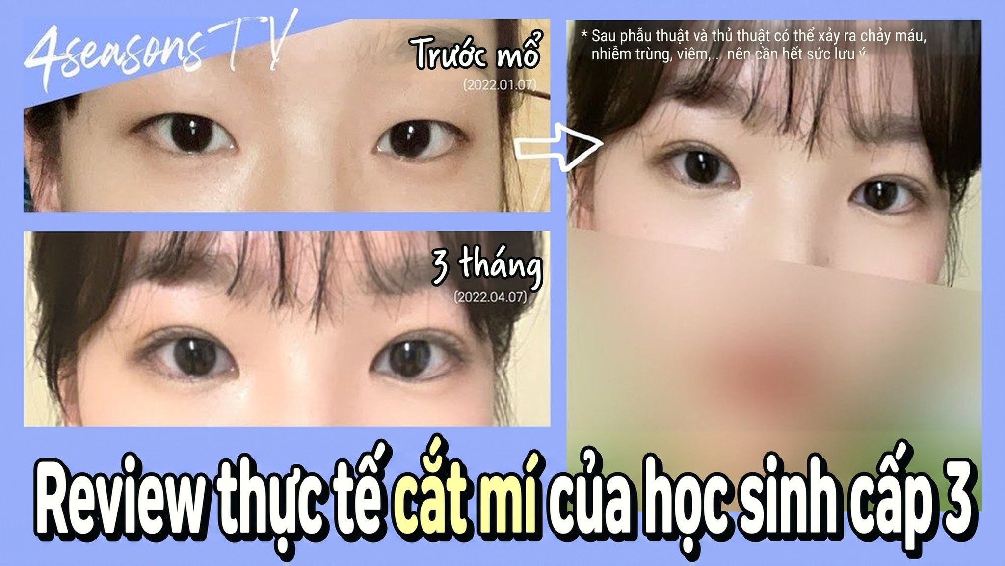 Ảnh thu nhỏ video 4seasonsTV - Review thực tế cắt mí của học sinh cấp 3, so sánh mắt trước phẫu thuật (2022.01.07) và sau 3 tháng (2022.04.07)