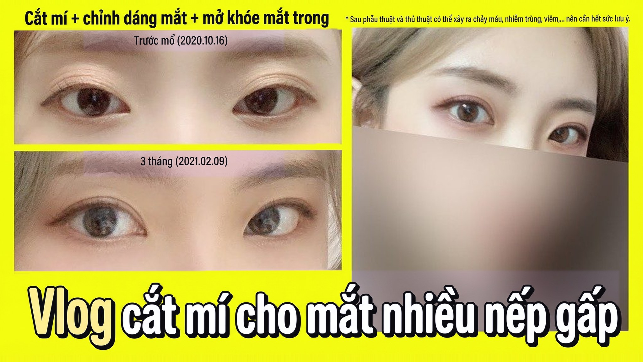 Ảnh thu nhỏ video 4seasonsTV - Vlog làm mắt hai mí cho mắt nhiều nếp gấp, cắt mí + chỉnh dáng mắt + mở góc mắt trong, so sánh mắt trước phẫu thuật (2020.10.16) và sau 3 tháng (2021.02.09)