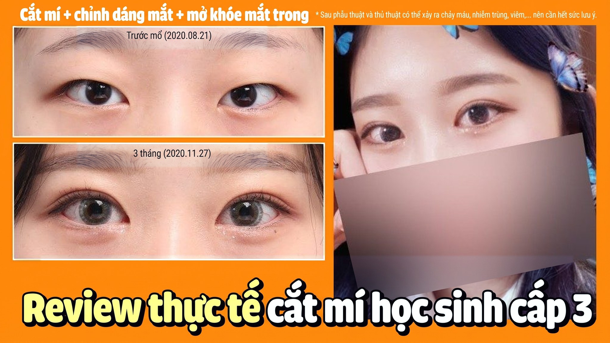 Ảnh thu nhỏ video 4seasonsTV - Review thực tế làm mắt hai mí của học sinh cấp 3, cắt mí + chỉnh dáng mắt + mở góc mắt trong, so sánh mắt trước phẫu thuật (2020.08.21) và sau 3 tháng (2020.11.27)