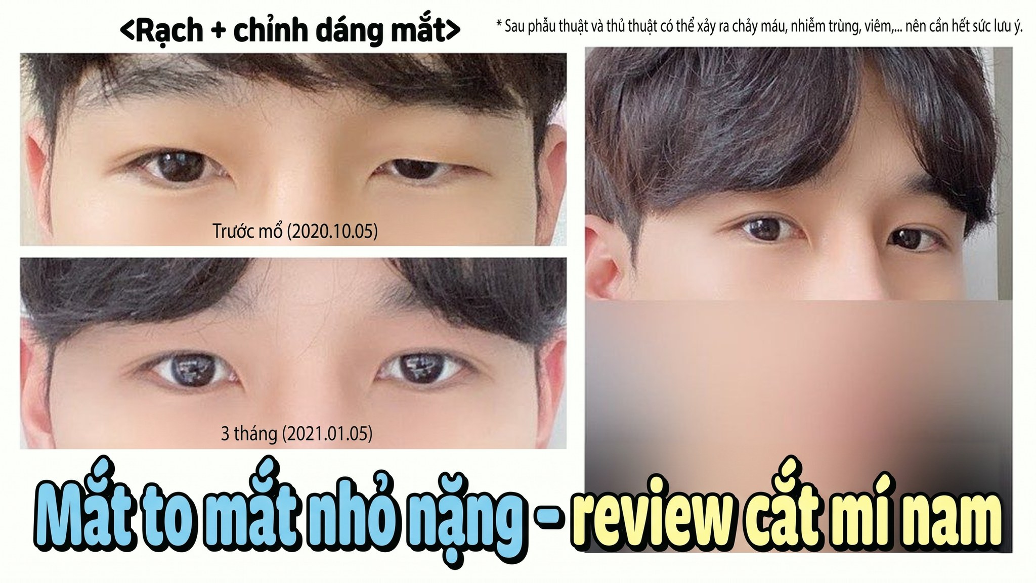 Ảnh thu nhỏ video 4seasonsTV - Review làm mắt hai mí của nam giới bị mắt to mắt nhỏ nặng, cắt mí + chỉnh dáng mắt, so sánh mắt trước phẫu thuật (2020.10.05) và sau 3 tháng (2021.01.05)