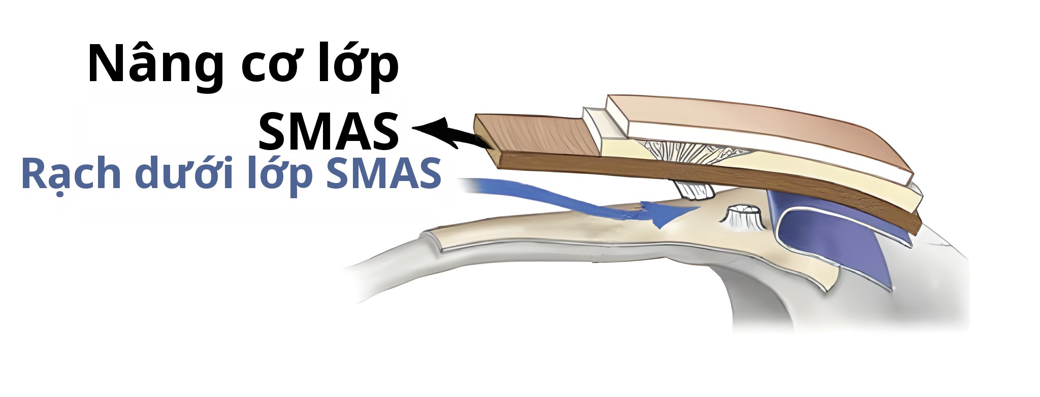 Sơ đồ mặt cắt khi lifting đến cả lớp SMAS — mũi tên được ghi “Lifting lớp SMAS”, mũi tên xanh được ghi “Rạch dưới lớp SMAS”