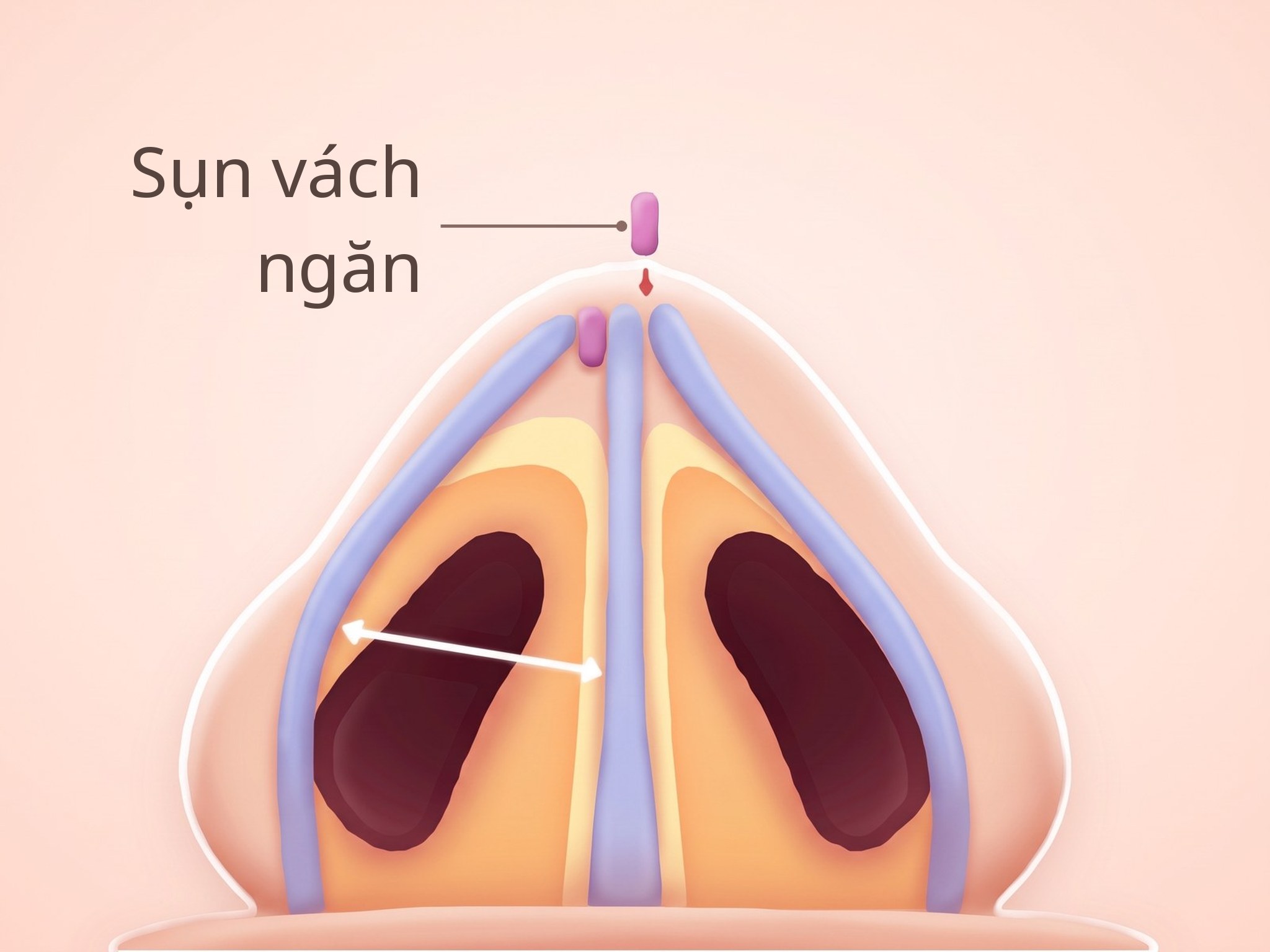 Hình minh họa bên trong mũi đã đặt mảnh ghép sụn vách ngăn, nhìn từ phía dưới