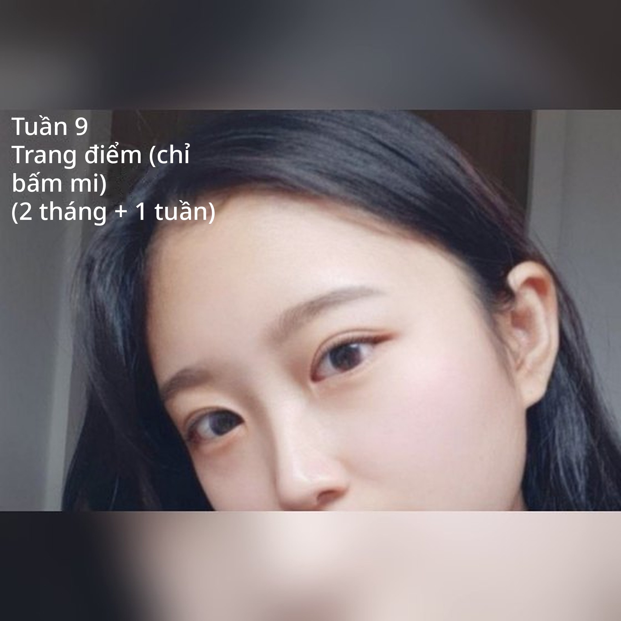 Ảnh thu nhỏ bài review phẫu thuật mắt — Review in-line / mở khóe trong / chỉnh dáng mắt