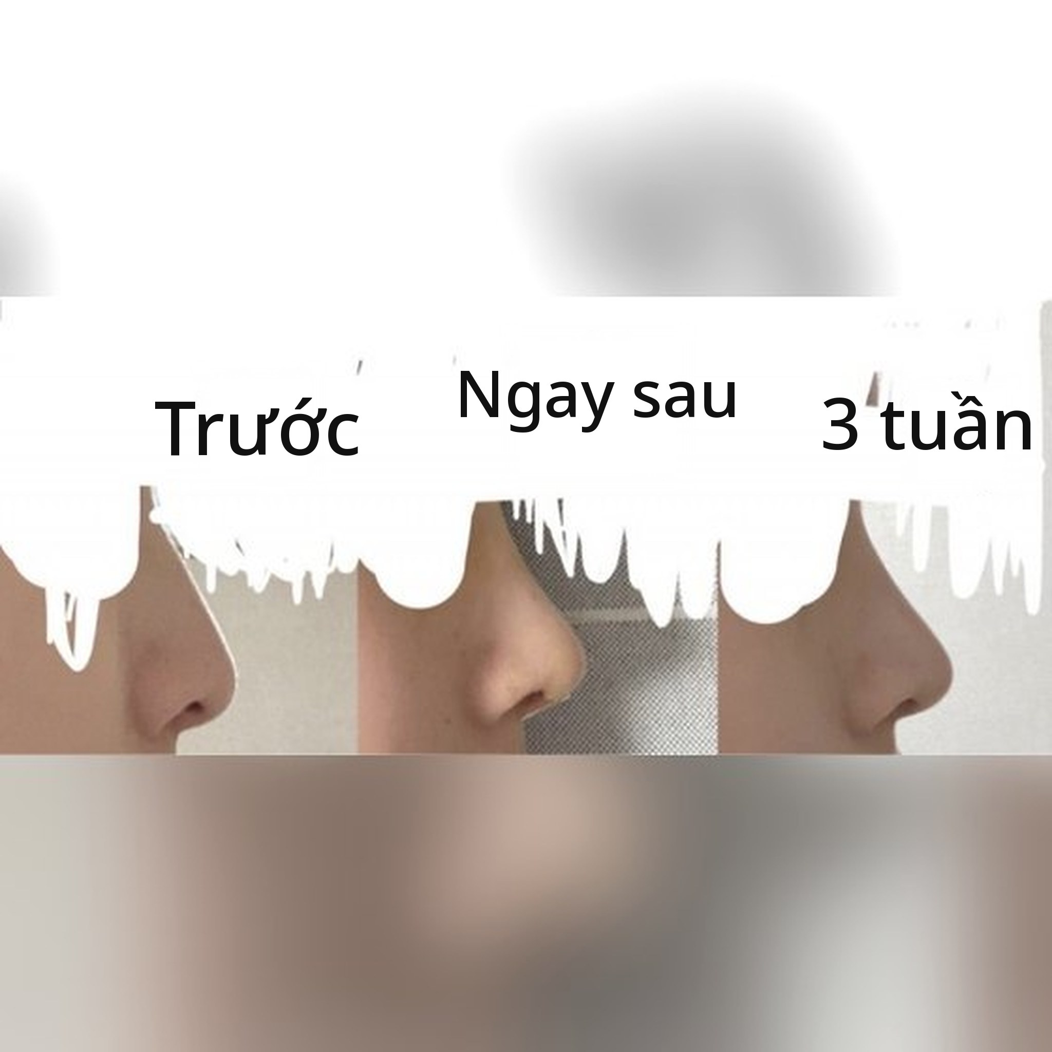 Ảnh thu nhỏ bài review phẫu thuật mũi — Giới thiệu phẫu thuật mũi với Bác sĩ Jegal Jeong⁠-⁠jae!!!^-^