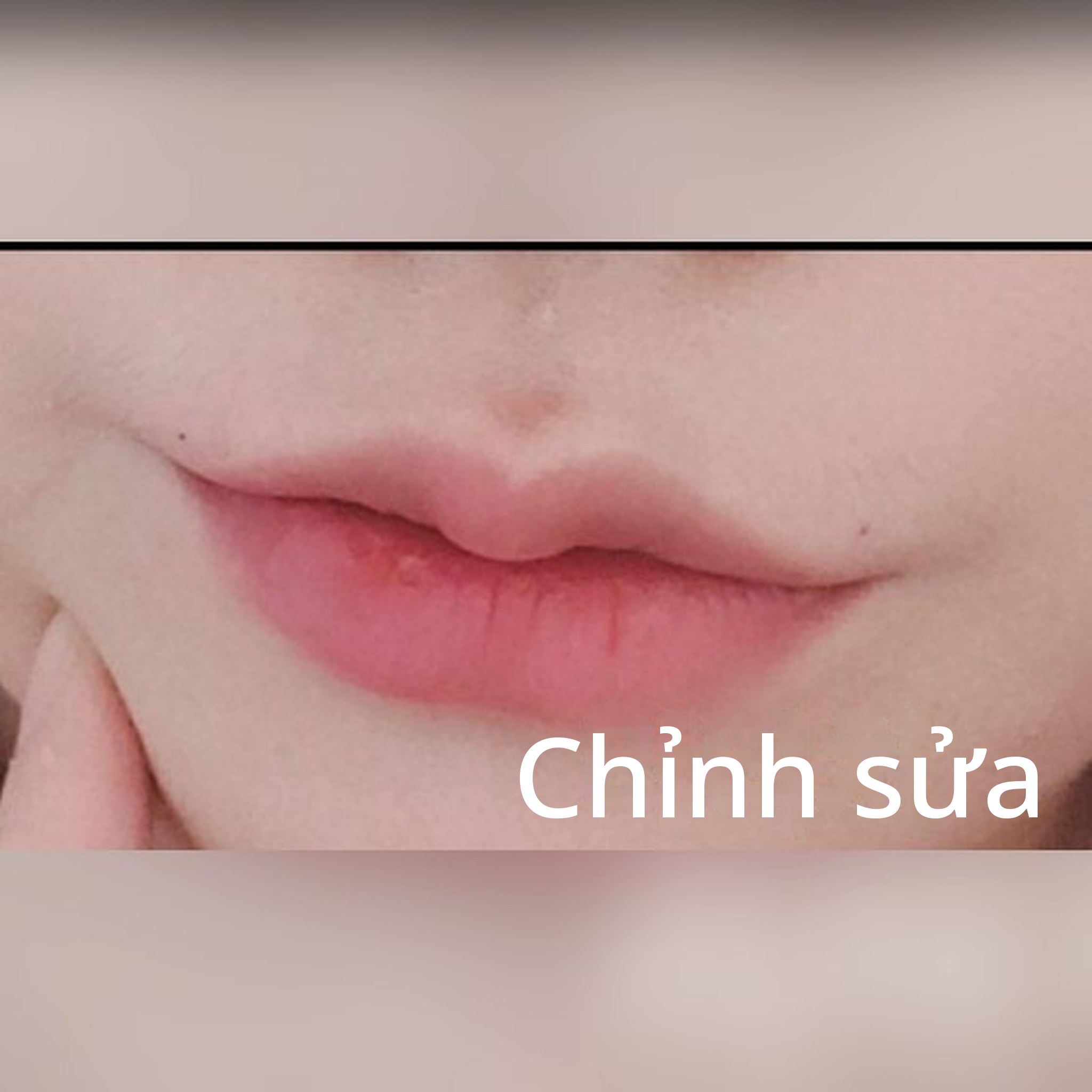 Ảnh thu nhỏ bài review thẩm mỹ không phẫu thuật — Có vẻ đây là nơi tiêm filler môi đỉnh nhất!! haha