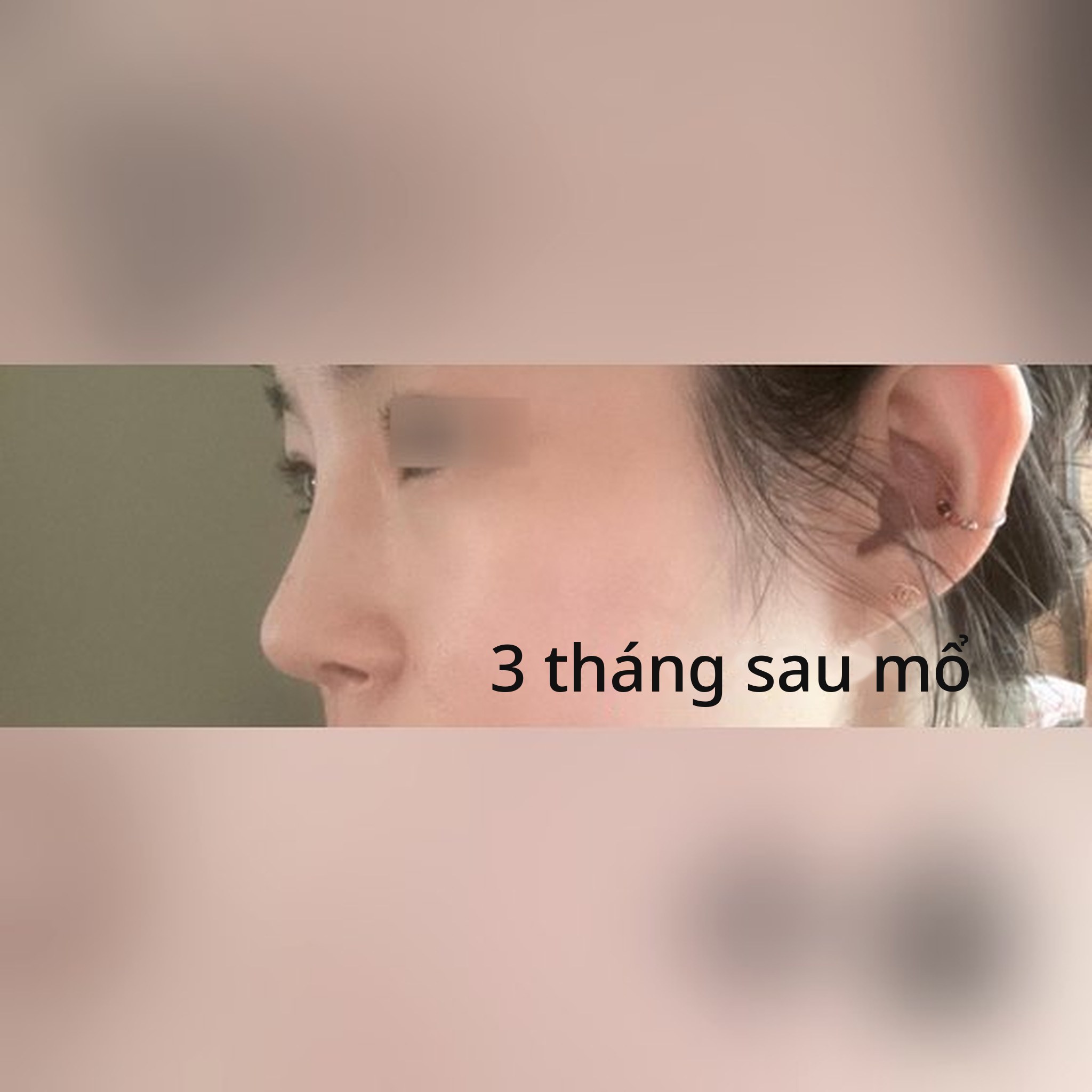 Ảnh thu nhỏ bài review thẩm mỹ mũi — Nâng mũi được 3 tháng, hoàn toàn hài lòng nè hihi